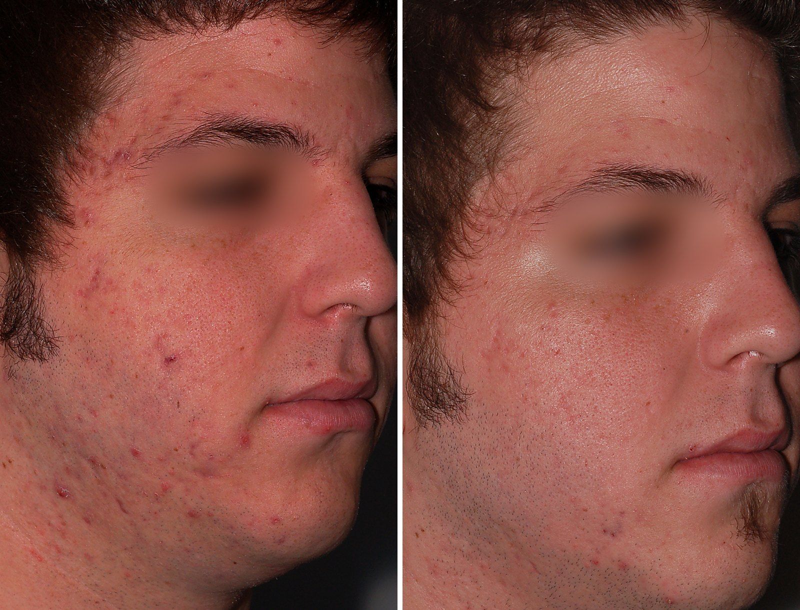 Before and after Acne treatment: Acne and texture, 5 SenzaLux treatments. Before on the left, after on the right.