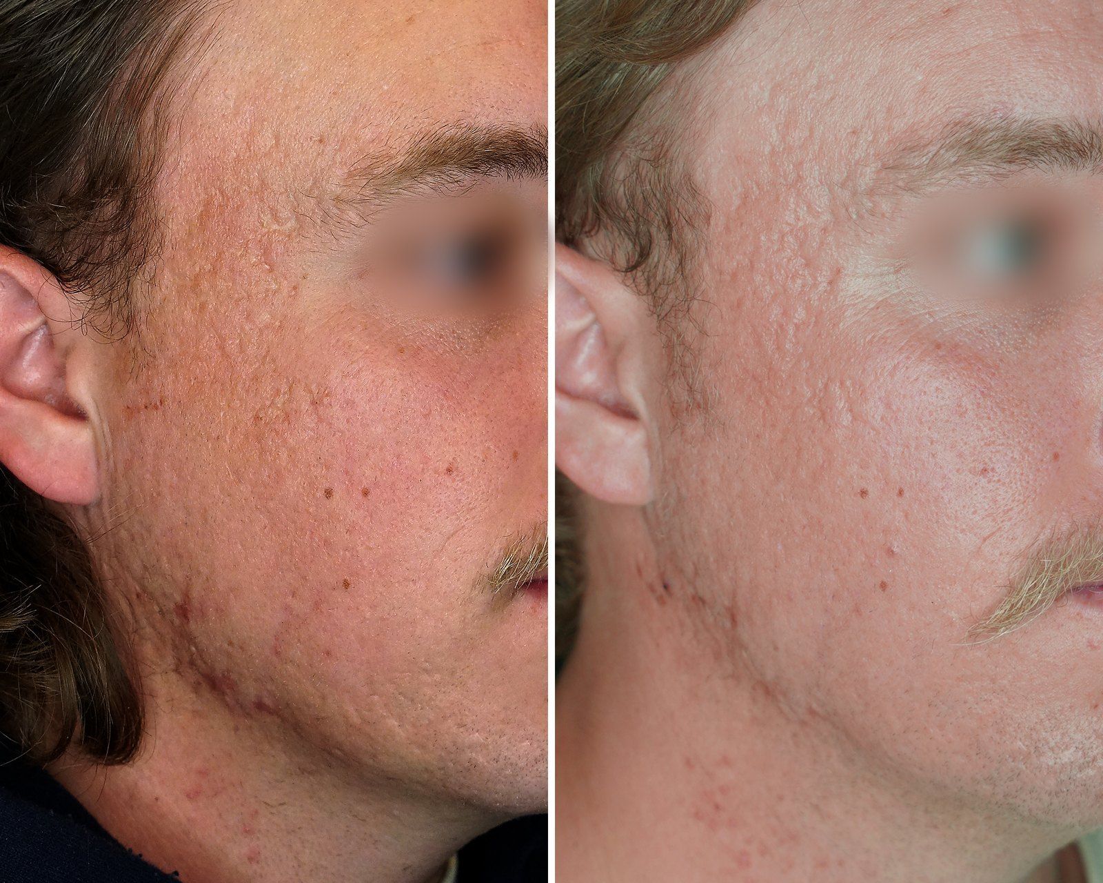 Before and after Acne treatment. Before on the left, after on the right.