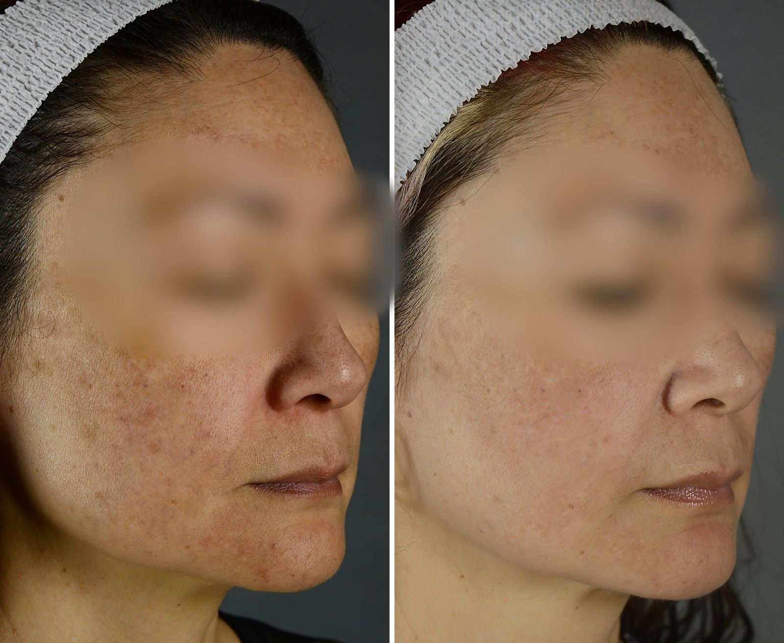 Chemical Peels before and after