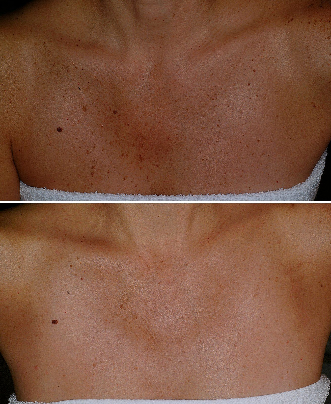 Before and after Skin rejuvenation: Chest. Before on the top, after on the bottom.