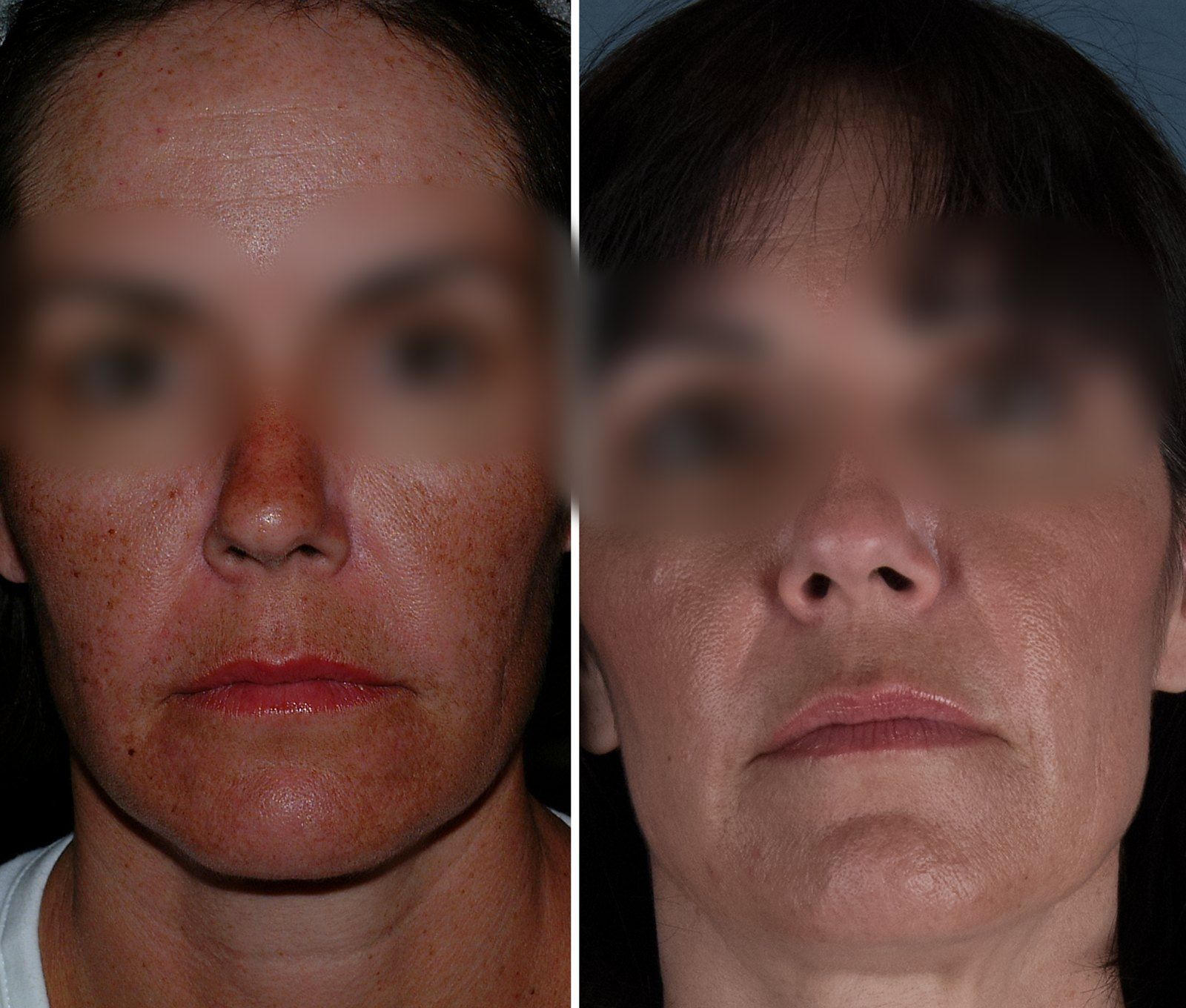 Facial Rejuvenation before and after