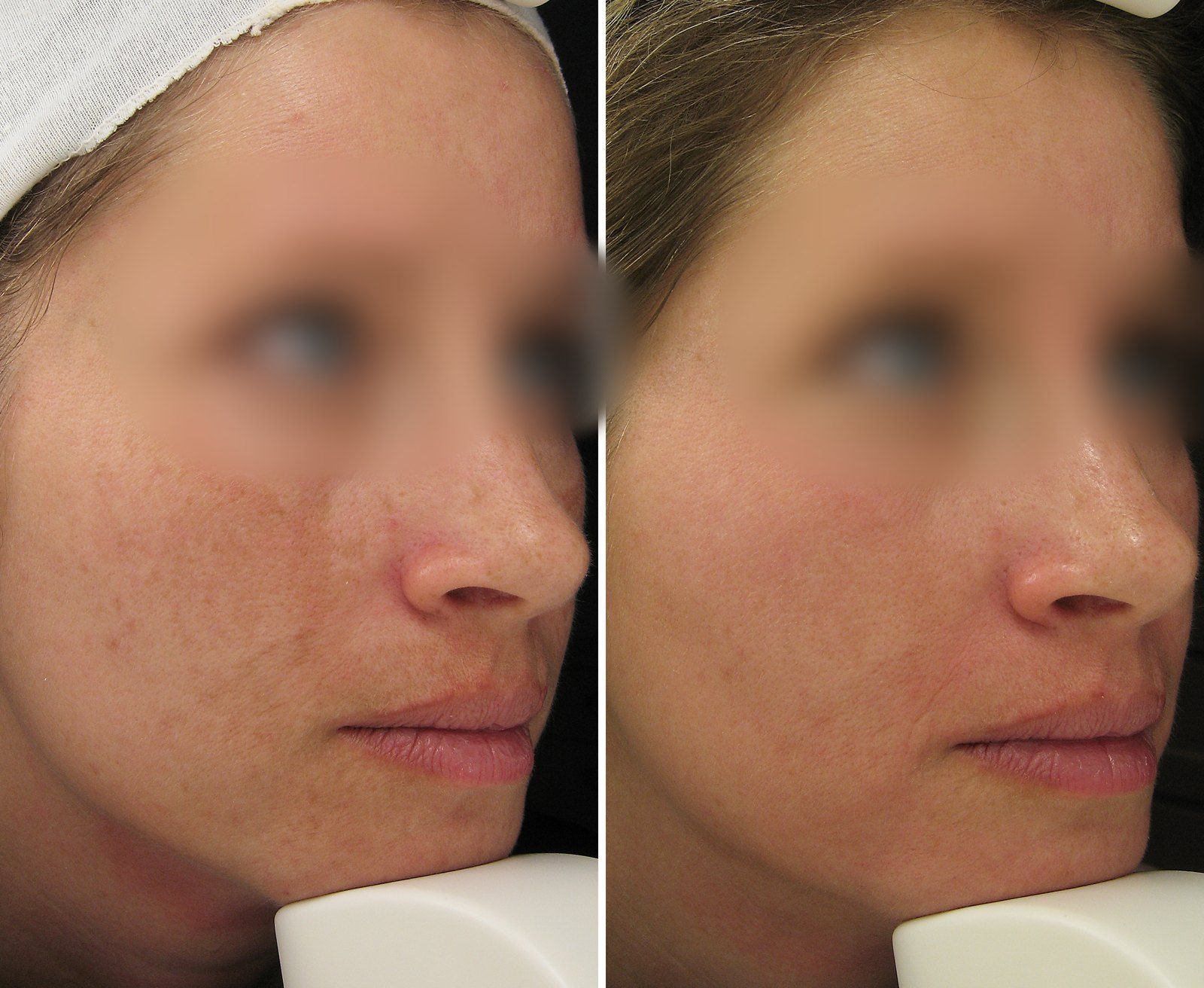 Before and after Facial rejuvenation. Before on the left, after on the right.