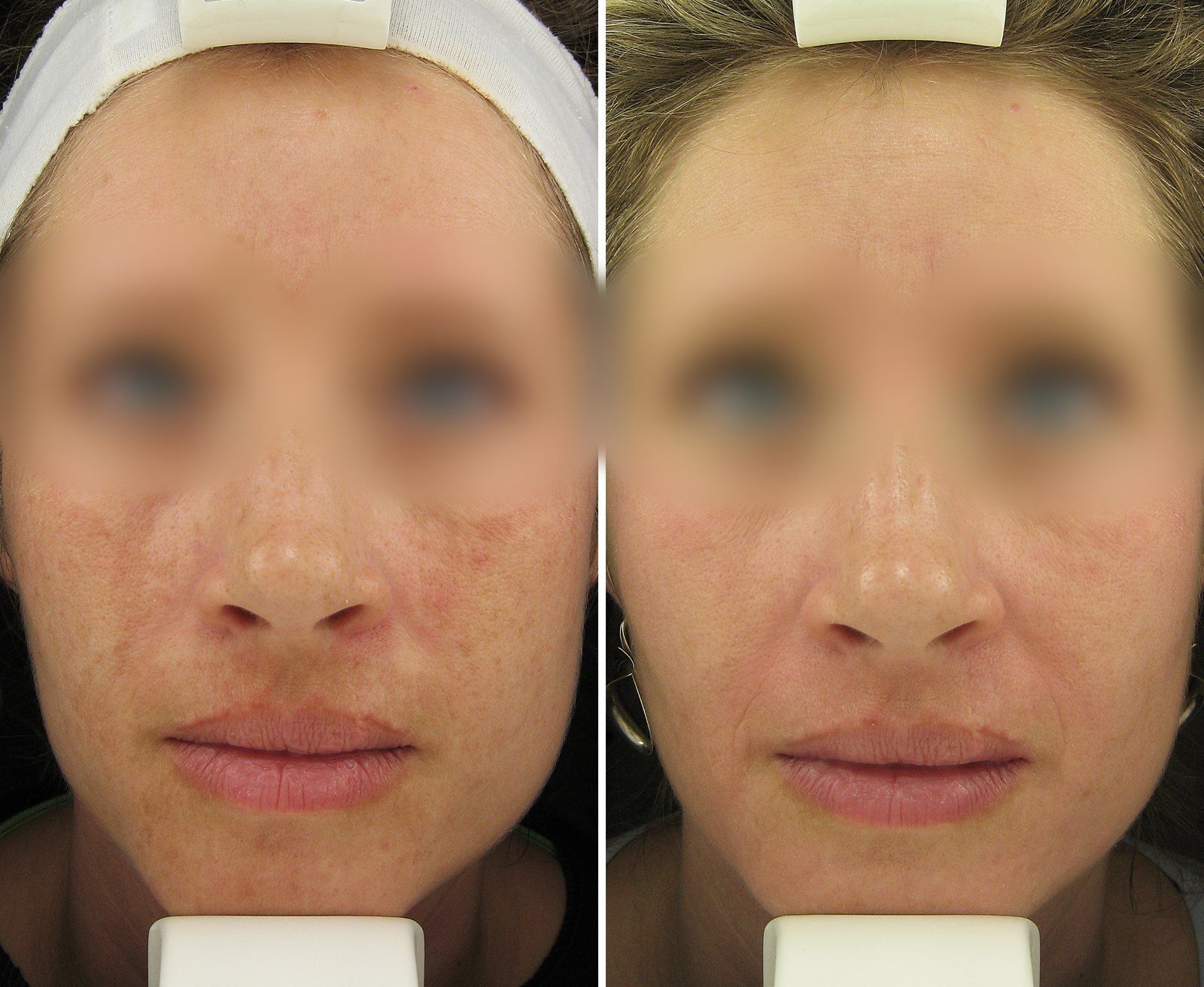 Before and after Facial rejuvenation. Before on the left, after on the right.