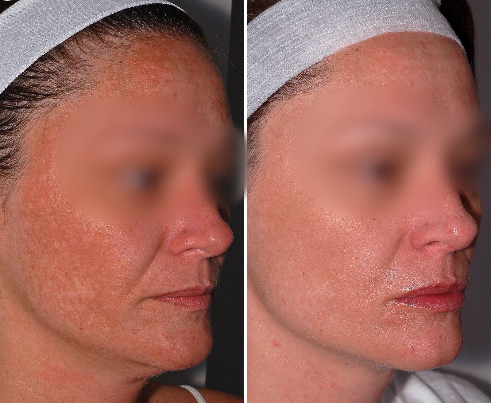Before and after Facial rejuvenation. Before on the left, after on the right.