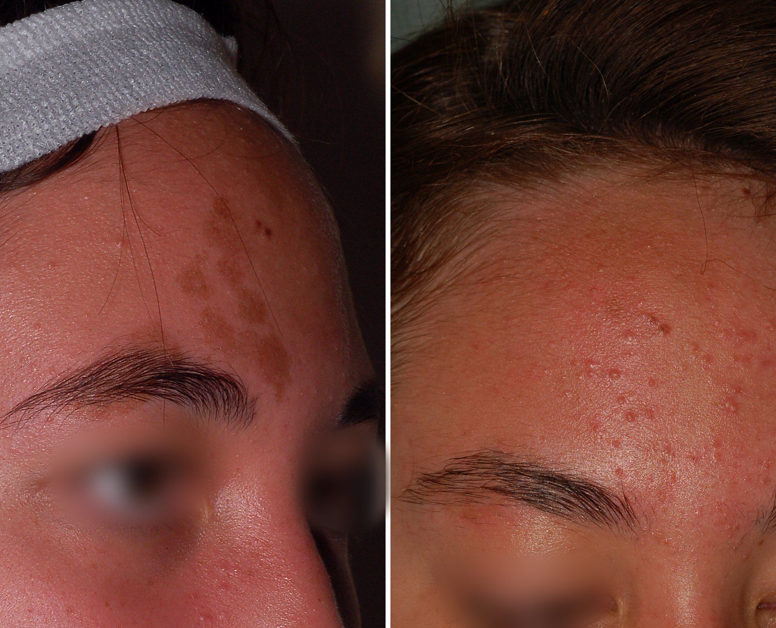 Before and after Facial rejuvenation. Before on the left, after on the right.