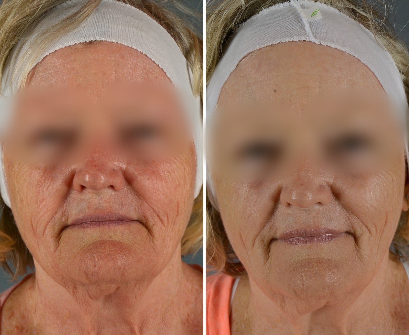 Before and after Facial rejuvenation. Before on the left, after on the right.