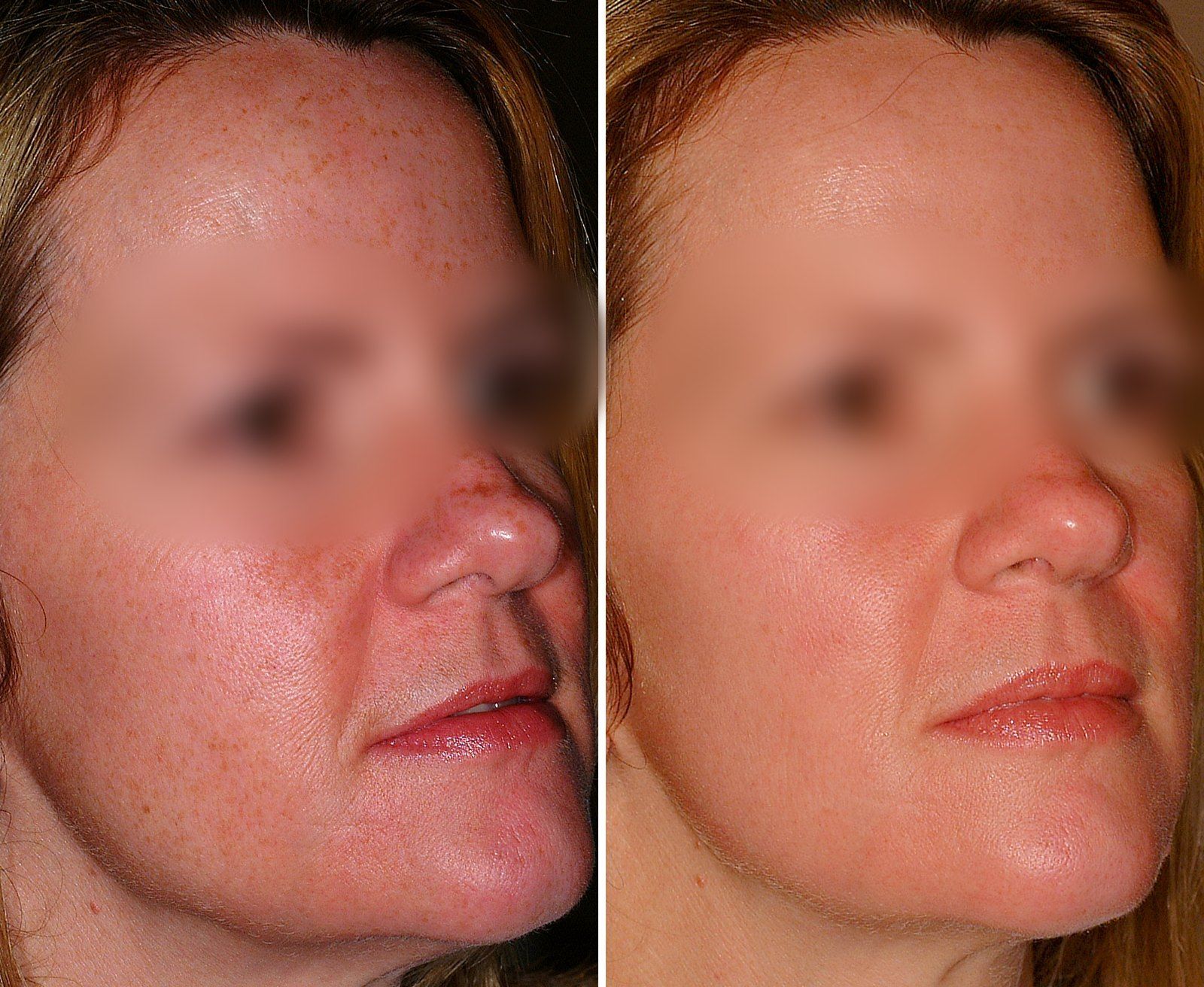 Before and after Facial rejuvenation. Before on the left, after on the right.