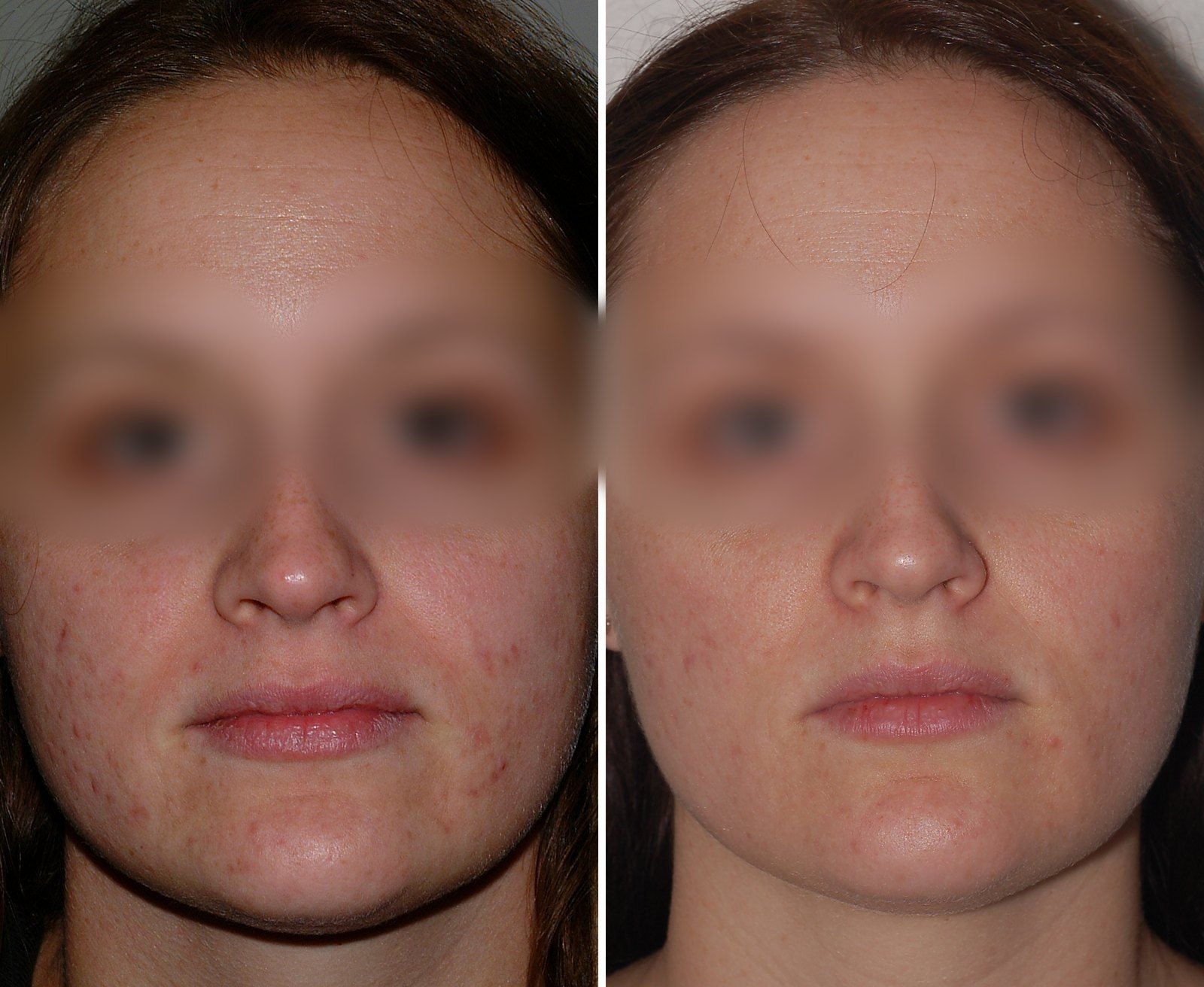 Before and after Facial rejuvenation. Before on the left, after on the right.