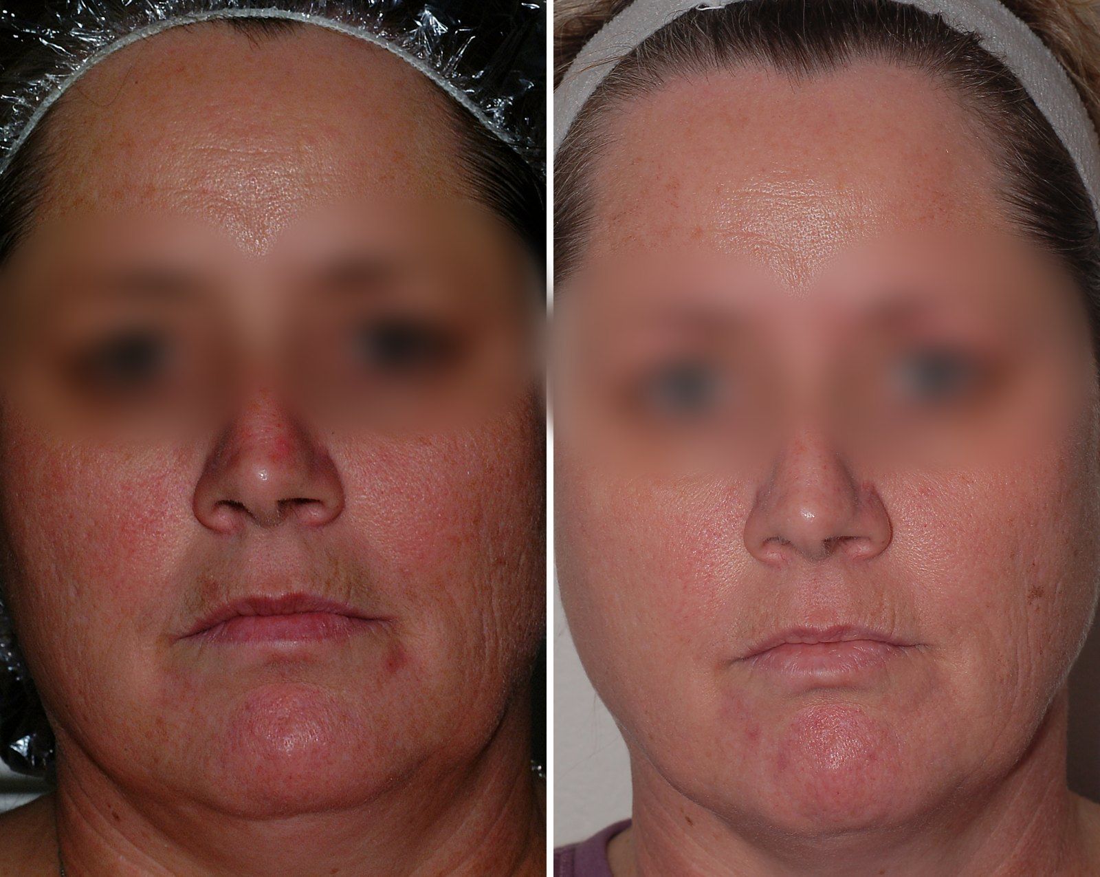 Before and after Facial rejuvenation. Before on the left, after on the right.