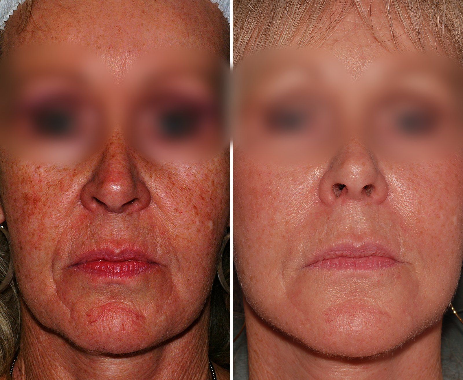 Before and after Facial rejuvenation. Before on the left, after on the right.