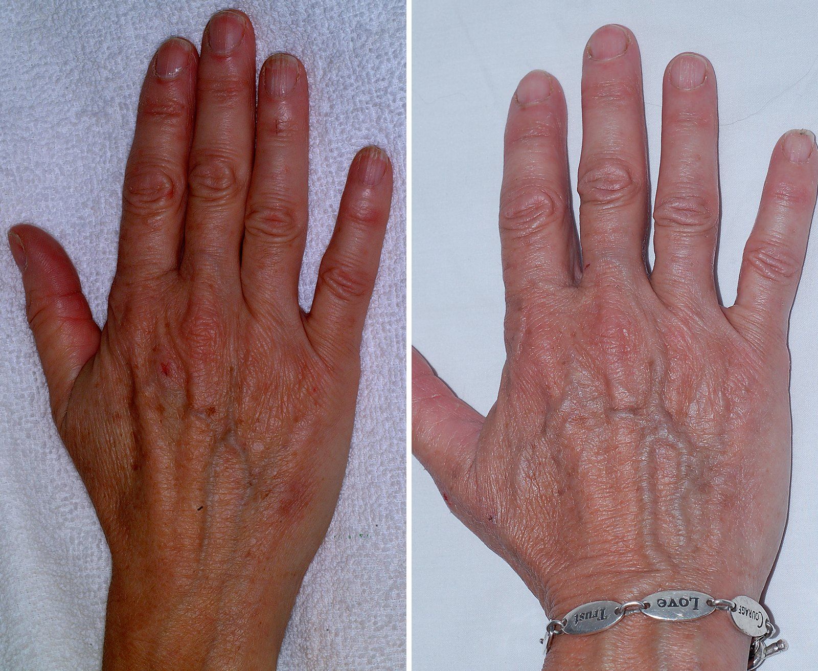 Before and after Skin rejuvenation: Hands. Before on the left, after on the right.