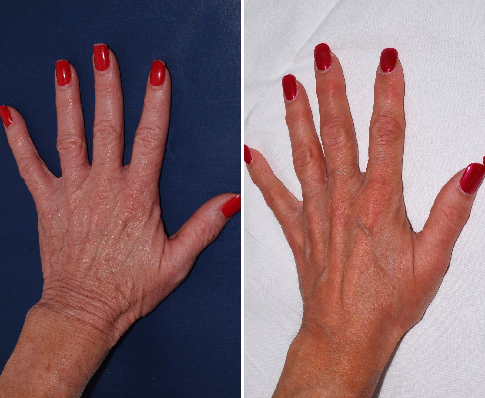 Before and after Skin rejuvenation: Hands. Before on the left, after on the right.