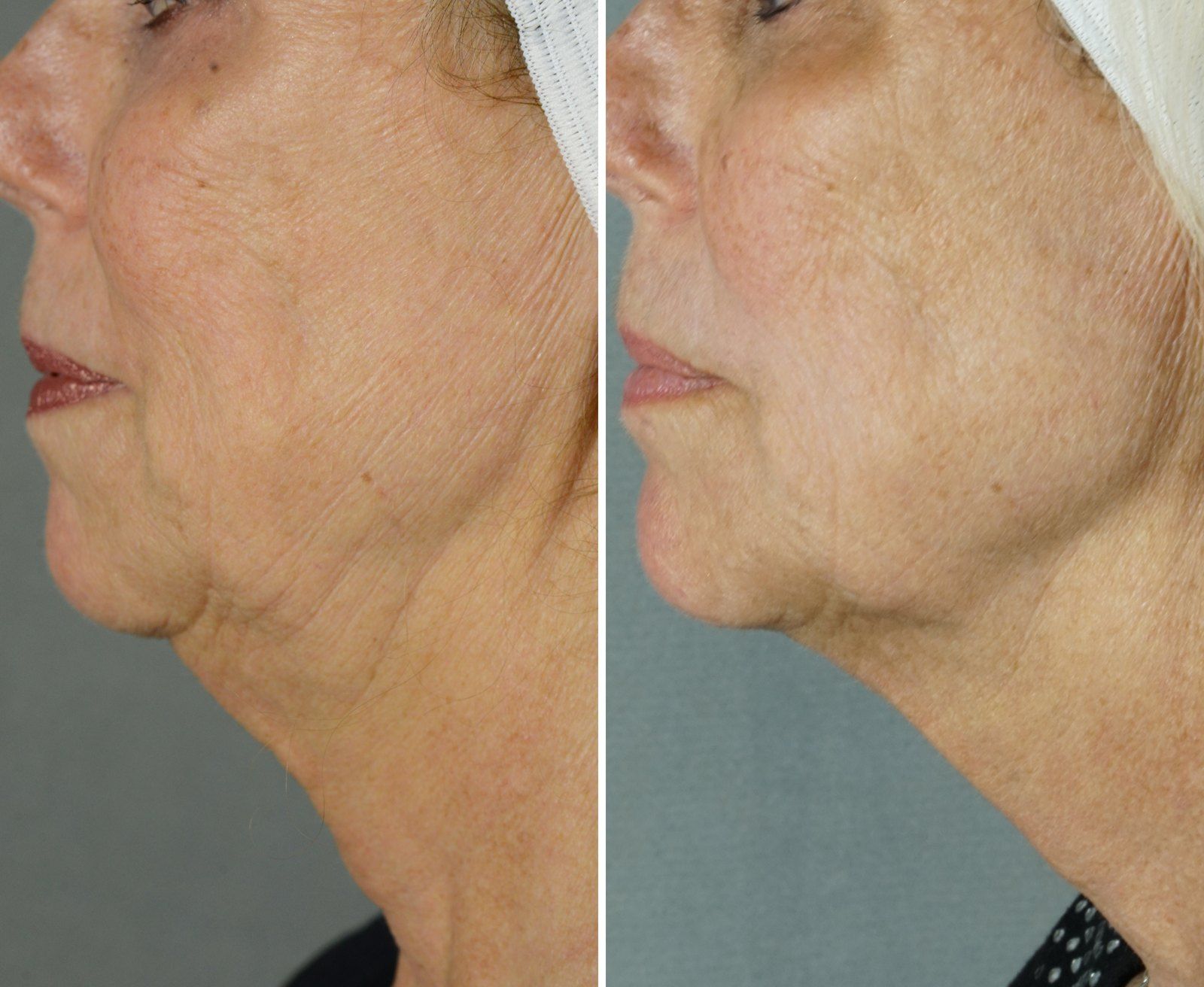 Before and after Skin rejuvenation: Neck. Before on the left, after on the right.