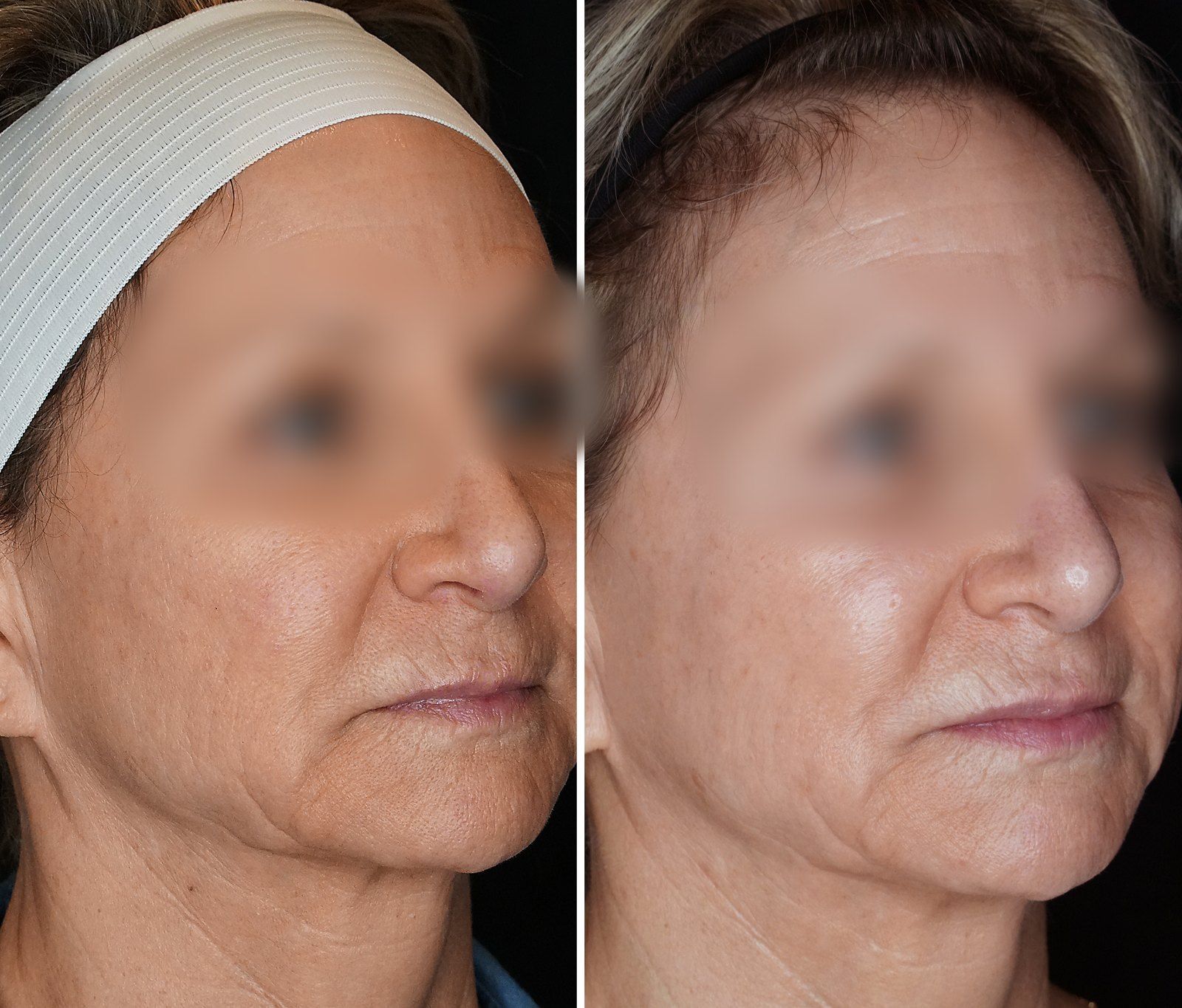 Before and after Facial rejuvenation. Before on the left, after on the right.