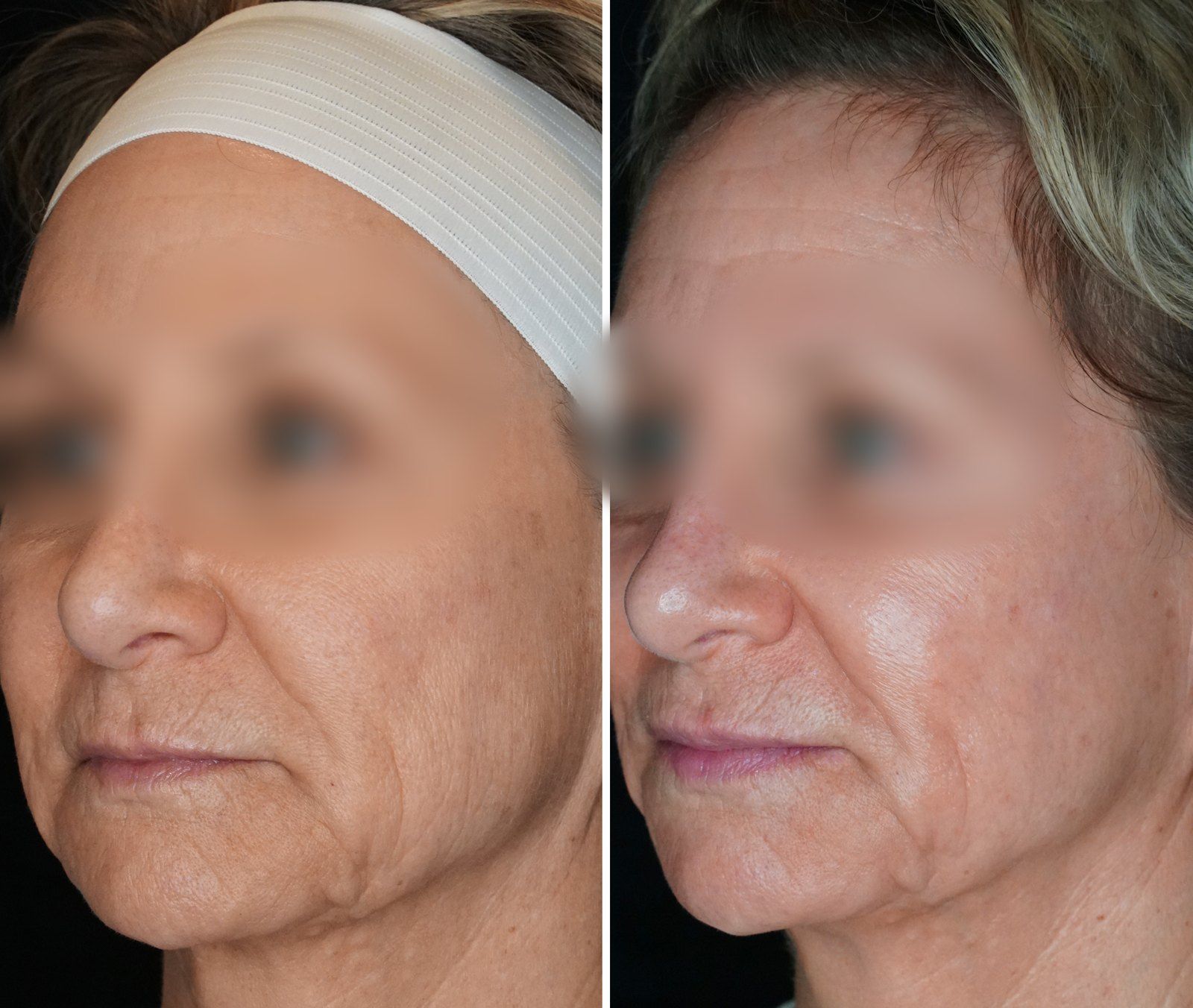 Before and after Facial rejuvenation. Before on the left, after on the right.