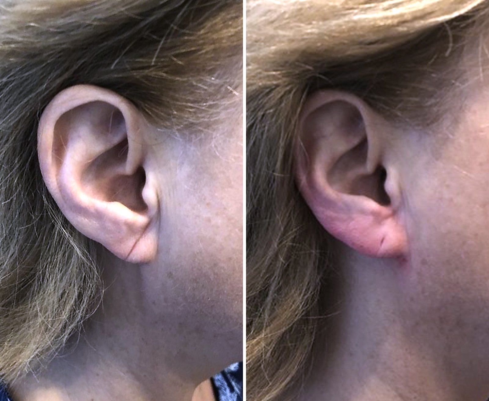 Before and after Dermal filler: Earlobe rejuvenation. Before on the left, after on the right.