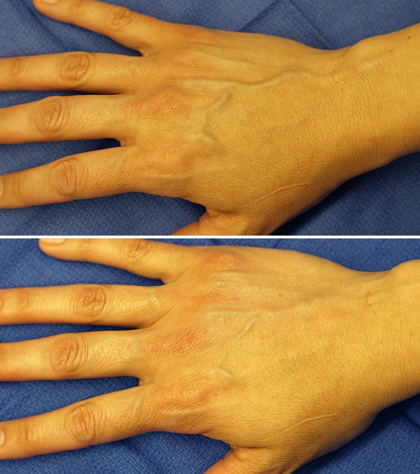 Before and after Dermal filler: Hand rejuvenation. Before on the top, after on the bottom.