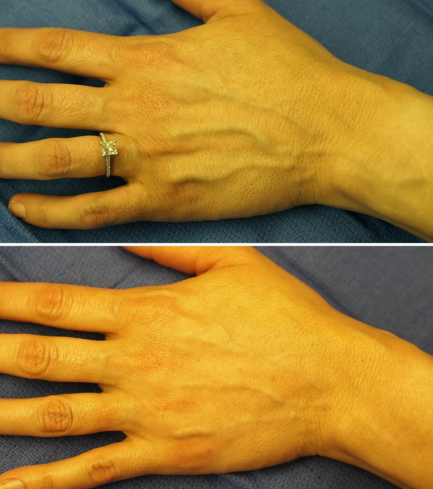 Before and after Dermal filler: Hand rejuvenation. Before on the top, after on the bottom.