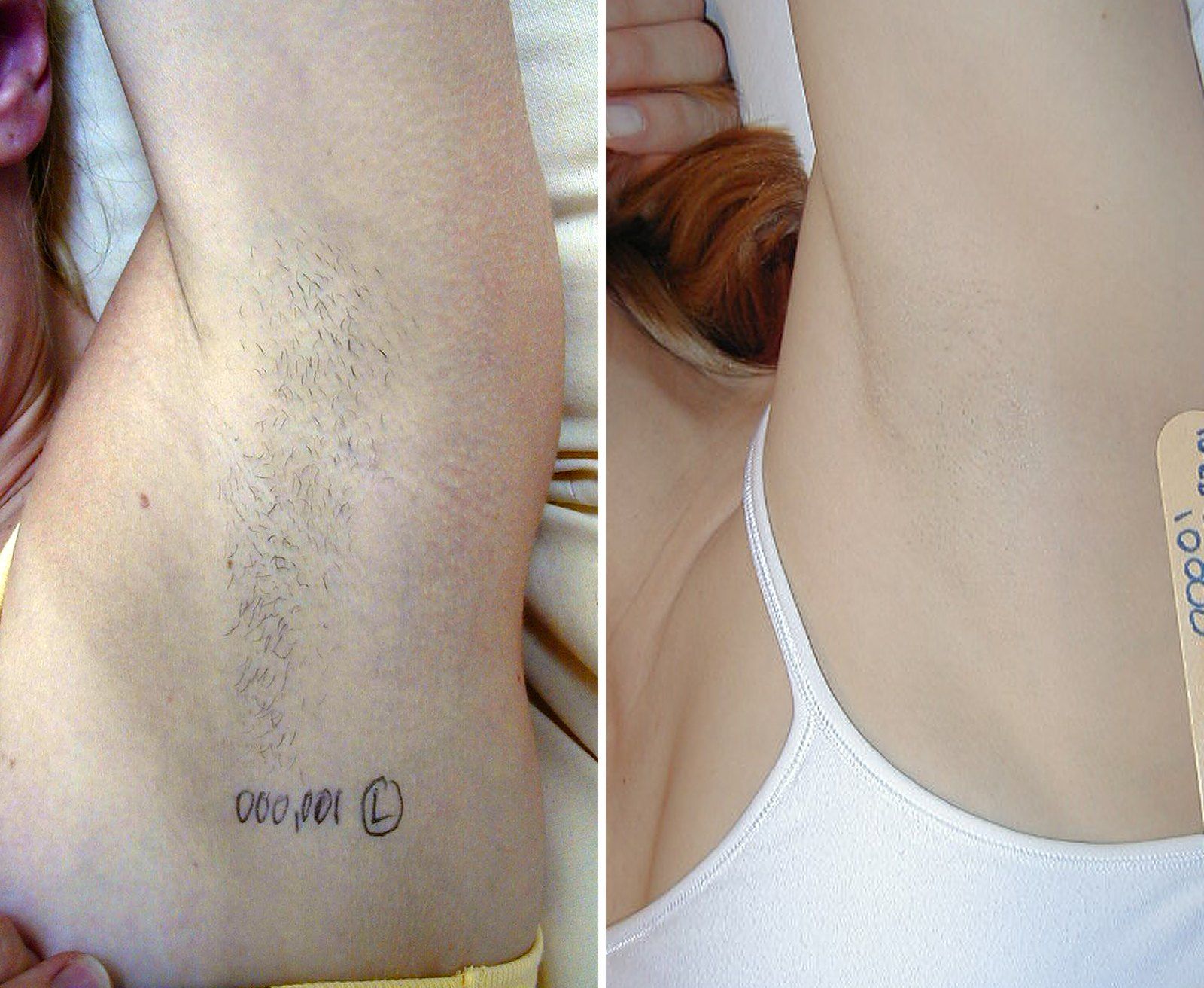 Before and after Laser hair removal. Before on the left, after on the right.