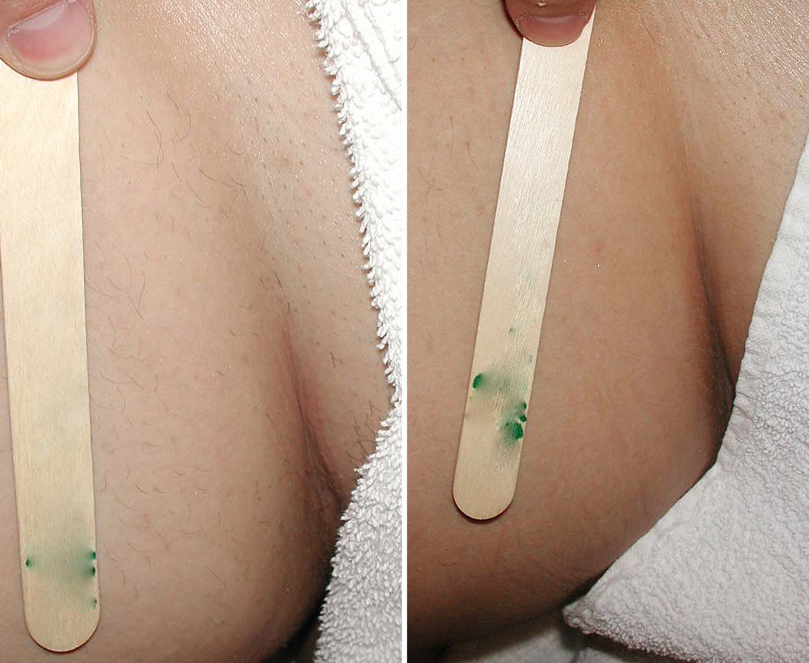 Before and after Laser hair removal. Before on the left, after on the right.