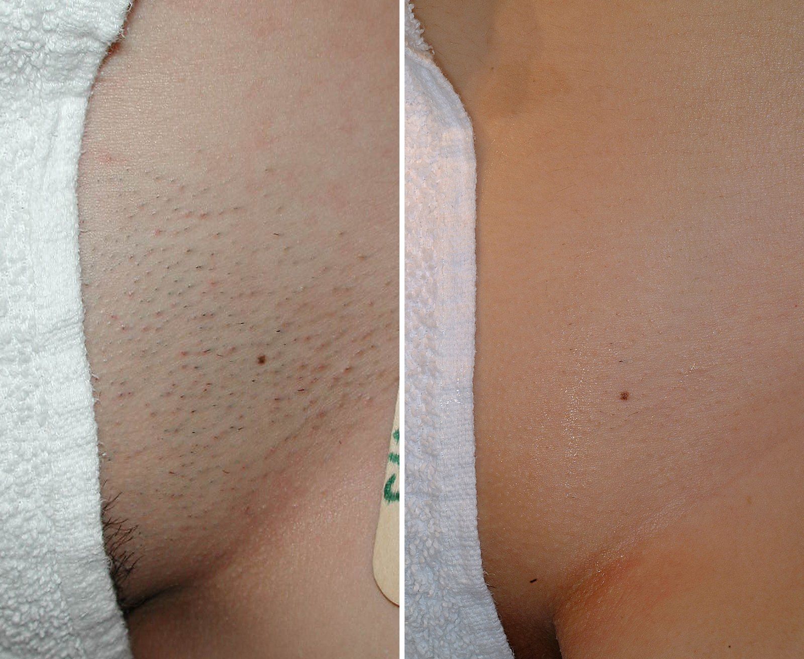 Before and after Laser hair removal. Before on the left, after on the right.