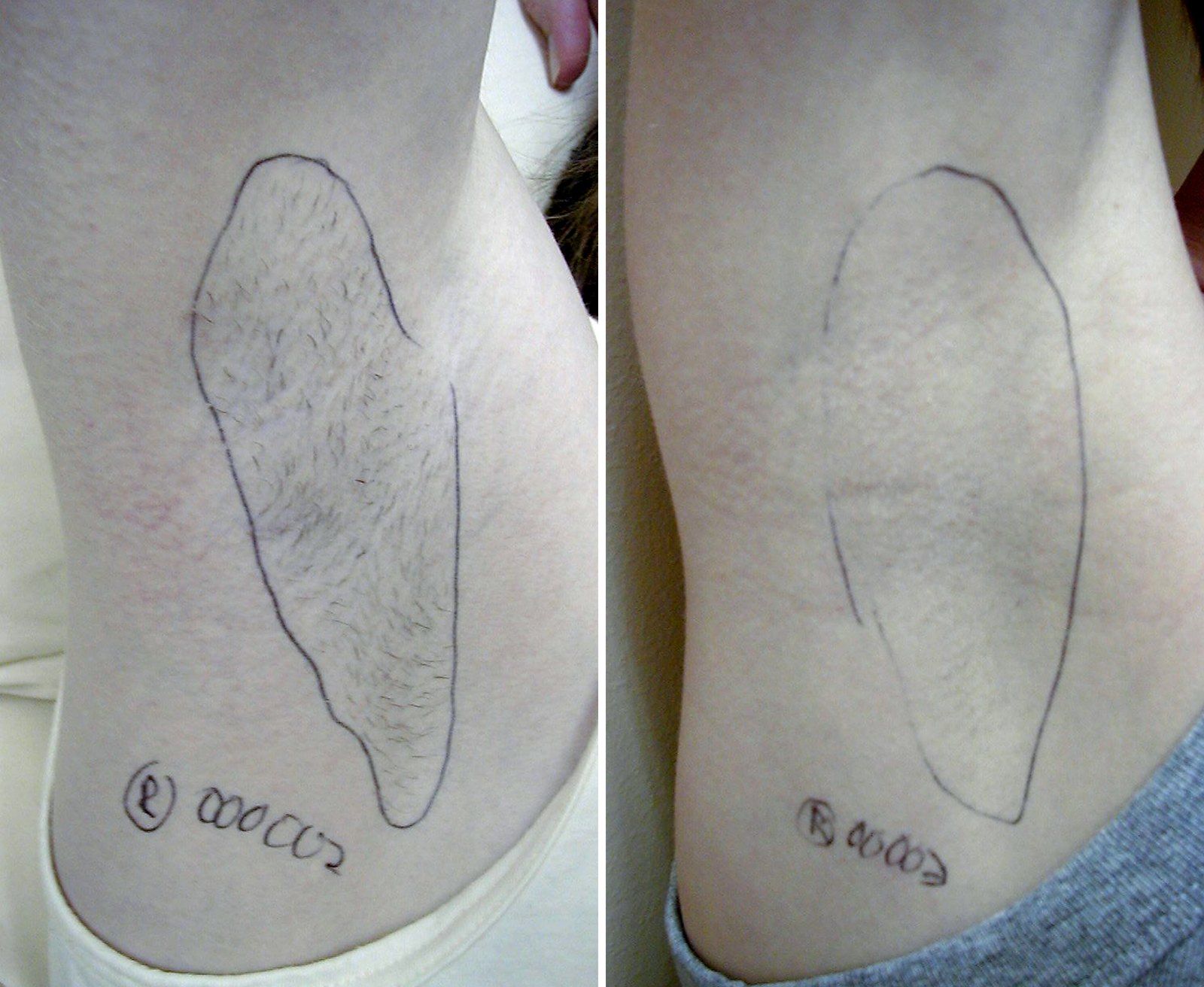Before and after Laser hair removal. Before on the left, after on the right.
