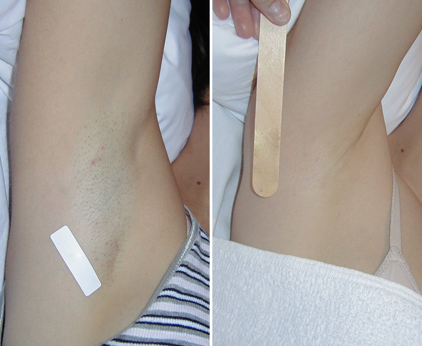Before and after Laser hair removal. Before on the left, after on the right.