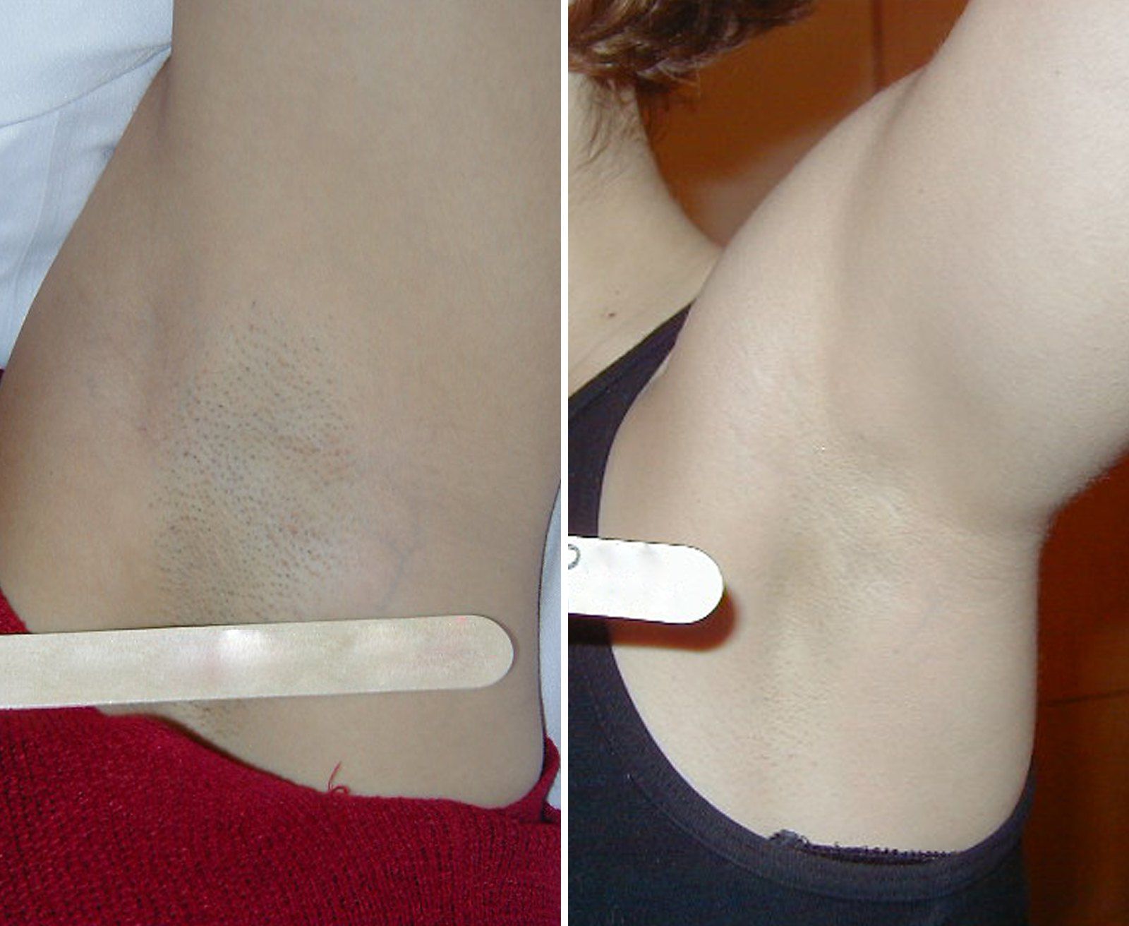 Before and after Laser hair removal. Before on the left, after on the right.