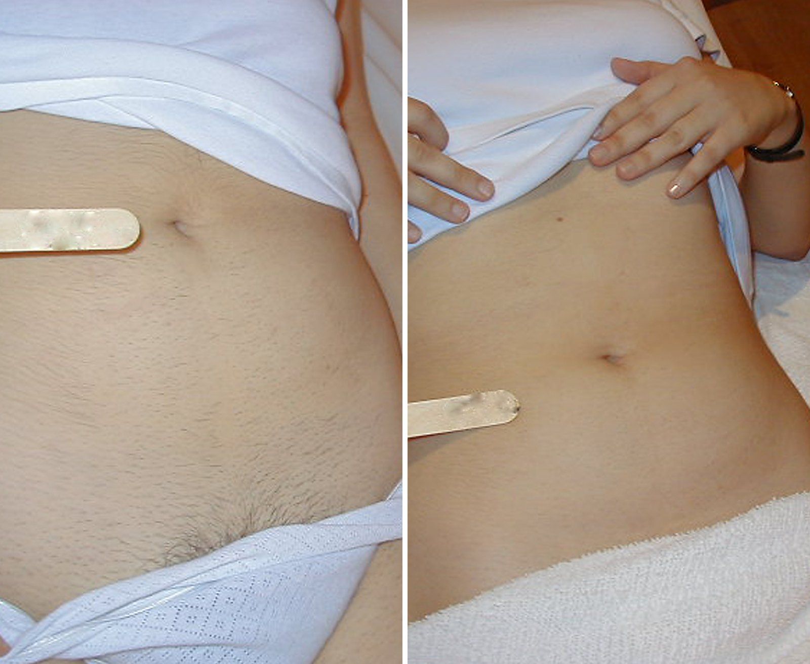 Before and after Laser hair removal. Before on the left, after on the right.
