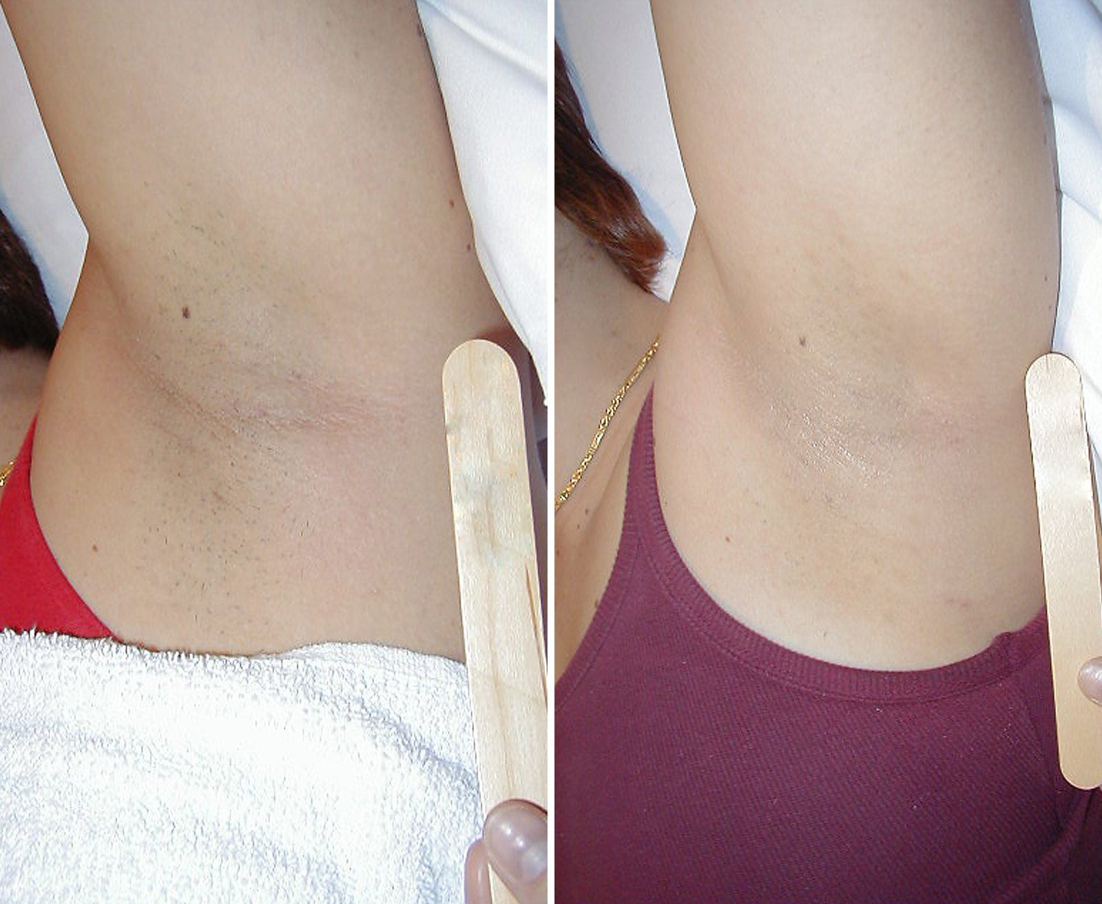 Before and after Laser hair removal. Before on the left, after on the right.