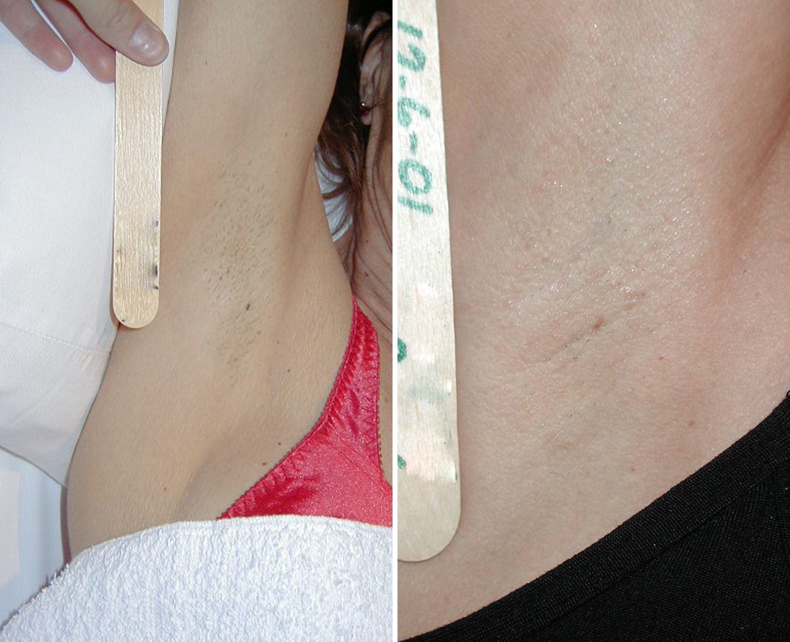 Before and after Laser hair removal. Before on the left, after on the right.