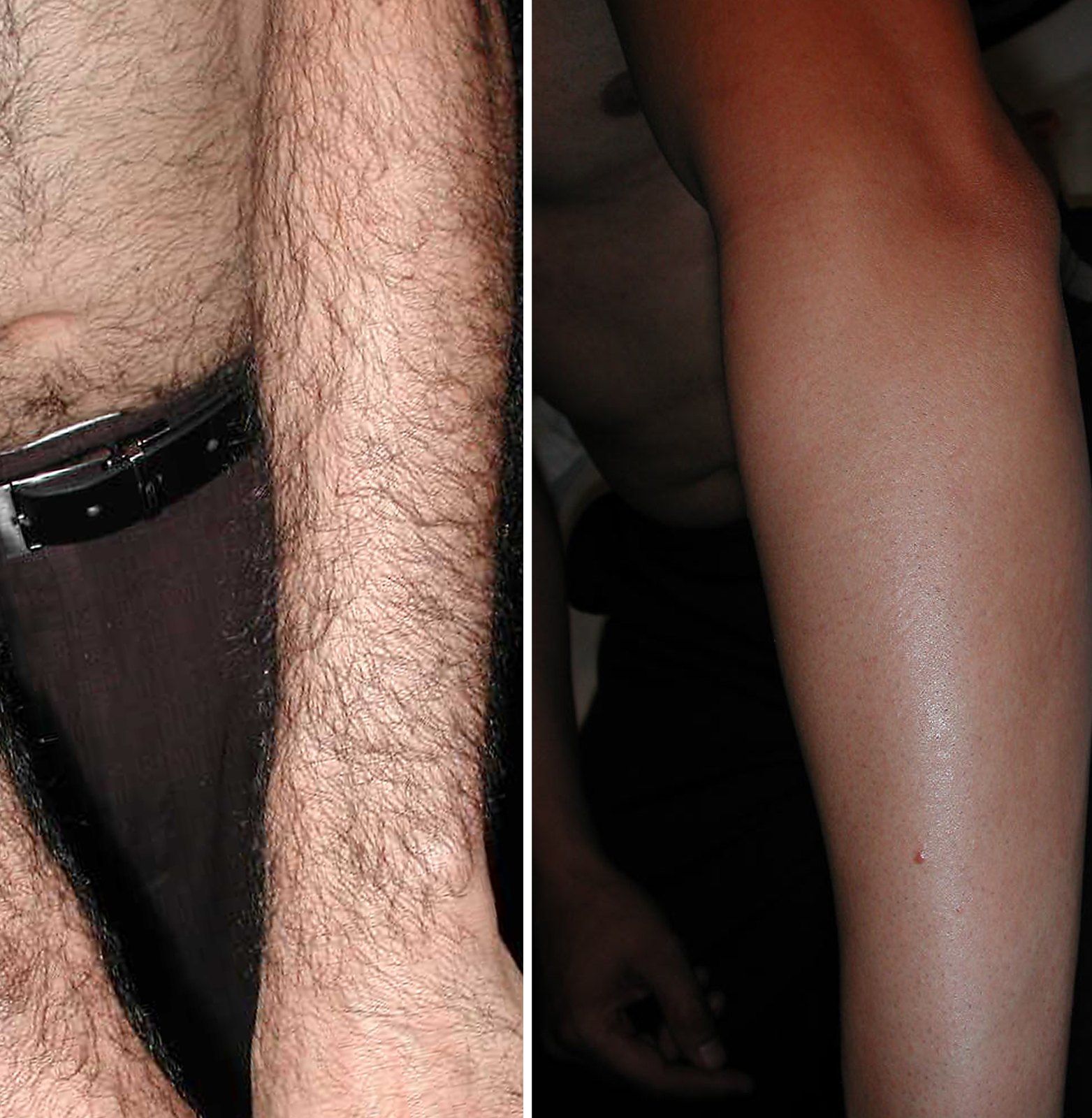 Before and after Laser hair removal. Before on the top, after on the bottom.