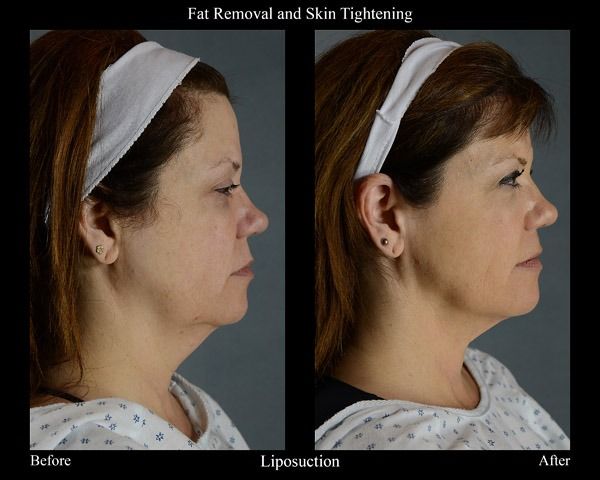 SenzaLipo before and after, Senza patient