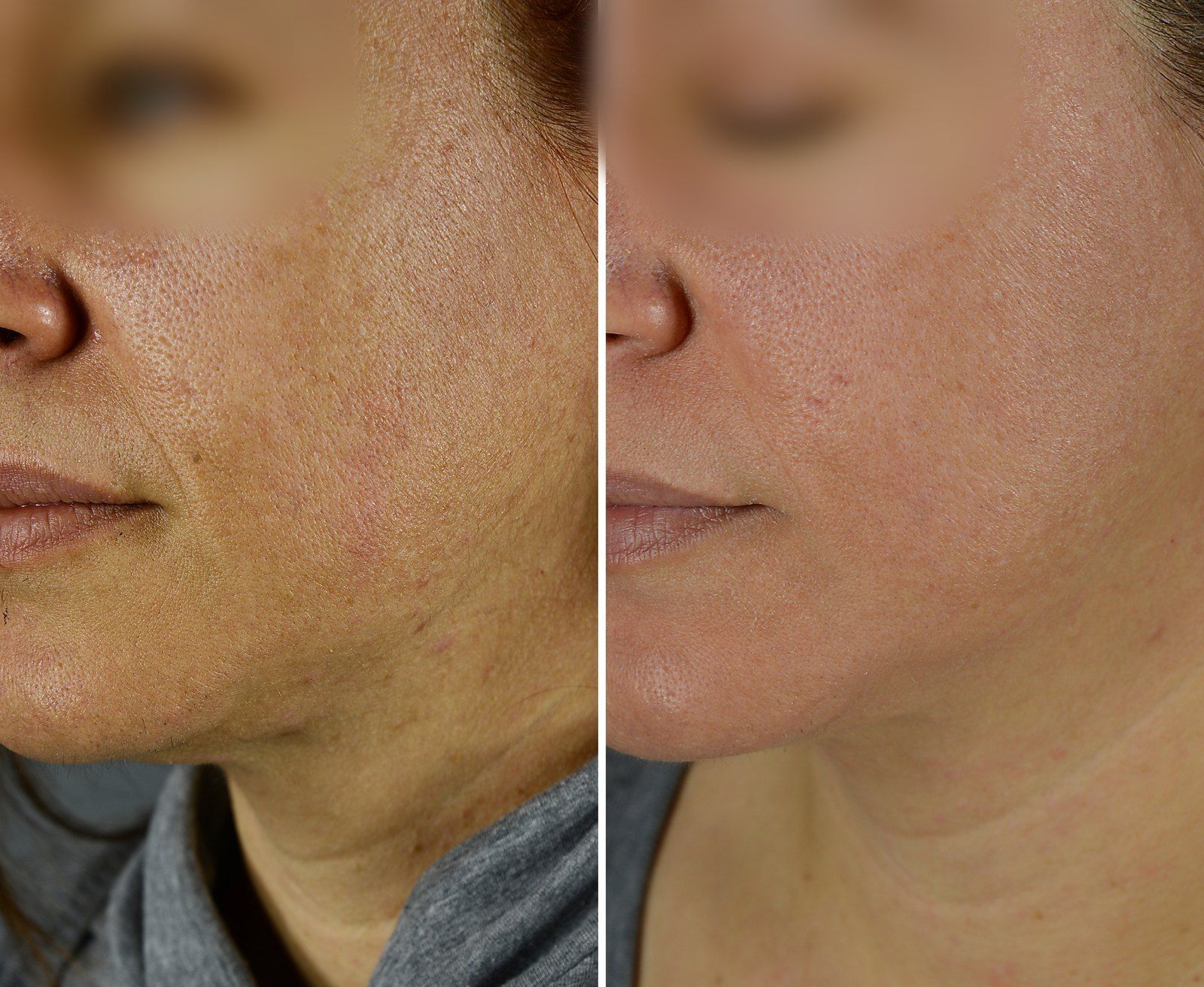 Microneedling before and after