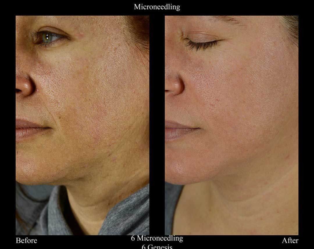 Microneedling before and after, Senza patient