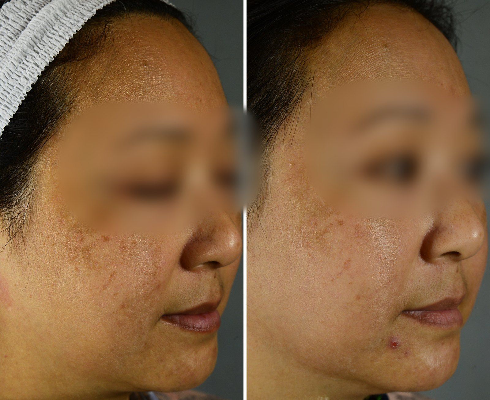 Pigmentation before and after