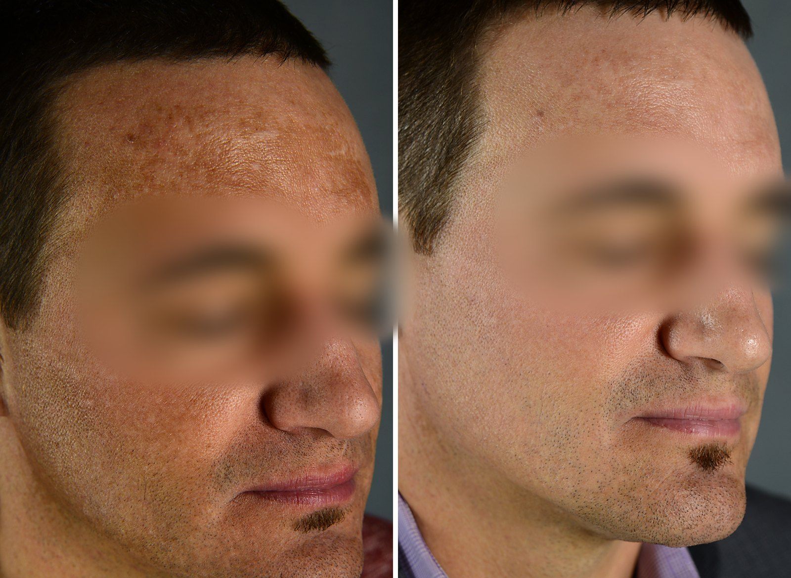 Before and after MedLite / PiQo4: Pigmentation, 10 treatments. Before on the left, after on the right.