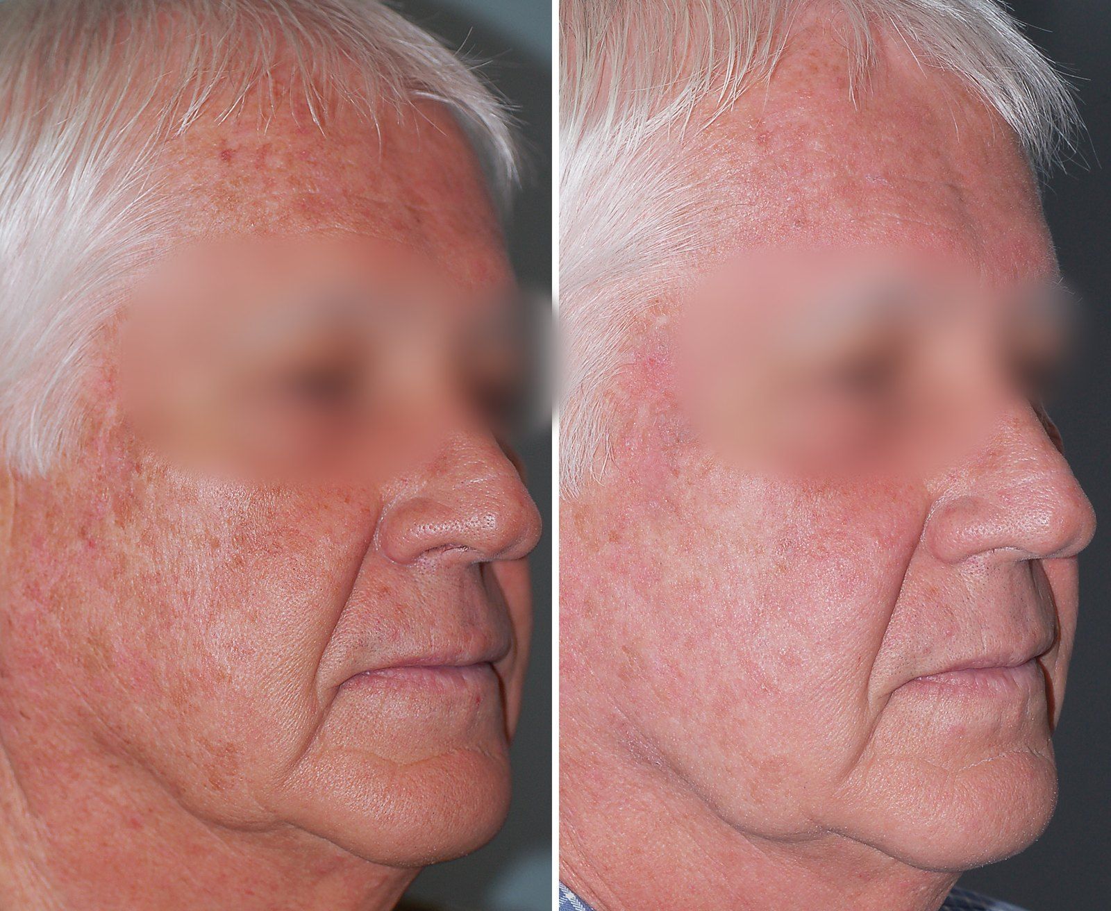 Before and after SenzaLux + MedLite: Texture & pigmentation. Before on the left, after on the right.
