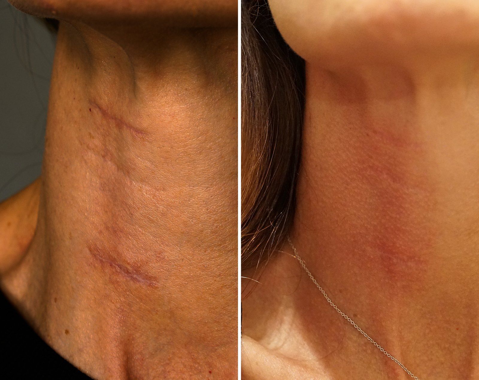 Before and after SenzaLux + microneedling: Neck texture, 2 SenzaLux and 1 PRP microneedling. Before on the left, after on the right.