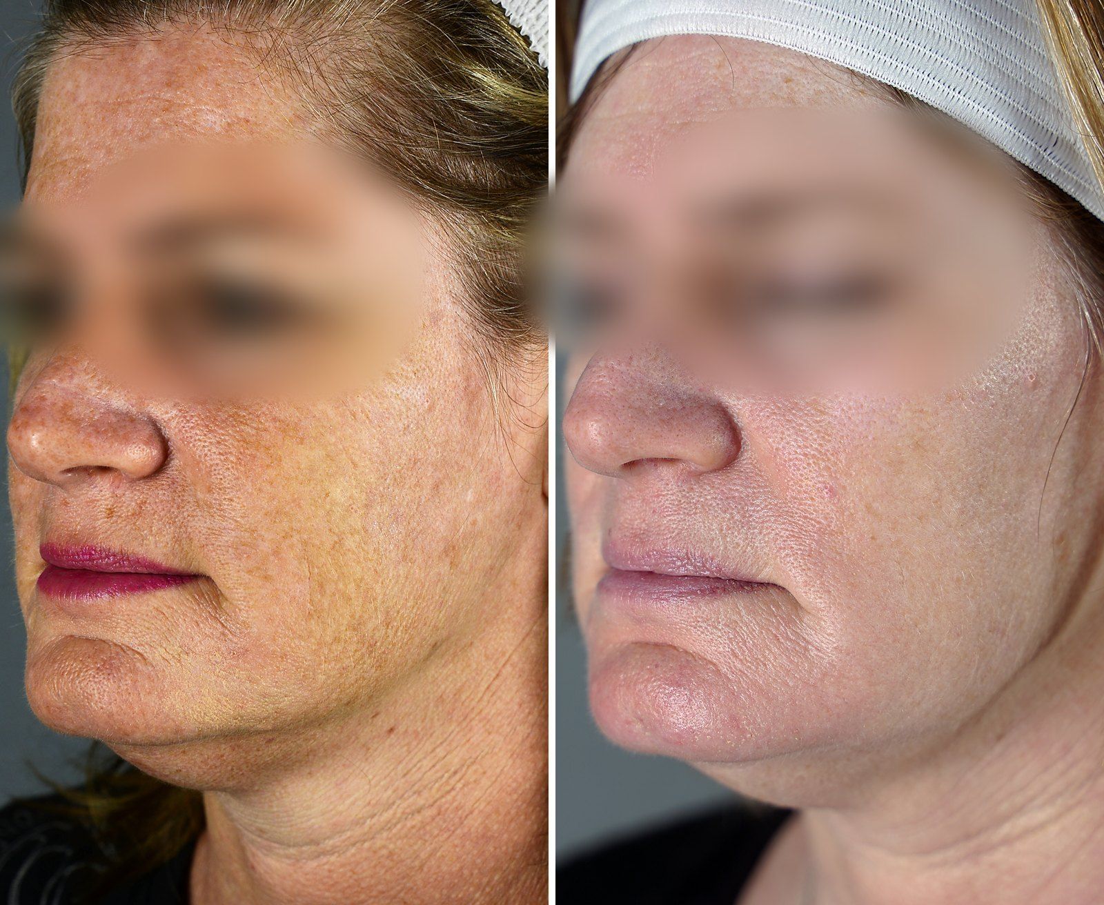 Before and after AesthetiClub + resurfacing: Five years of maintenance, 2014 to 2019. Before on the left, after on the right.