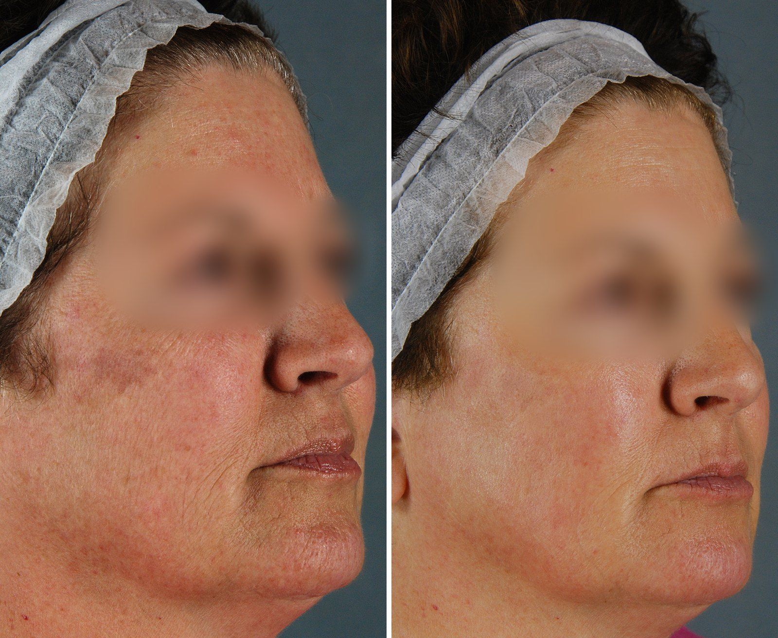 Before and after SenzaLux: Pigmentation & texture. Before on the left, after on the right.