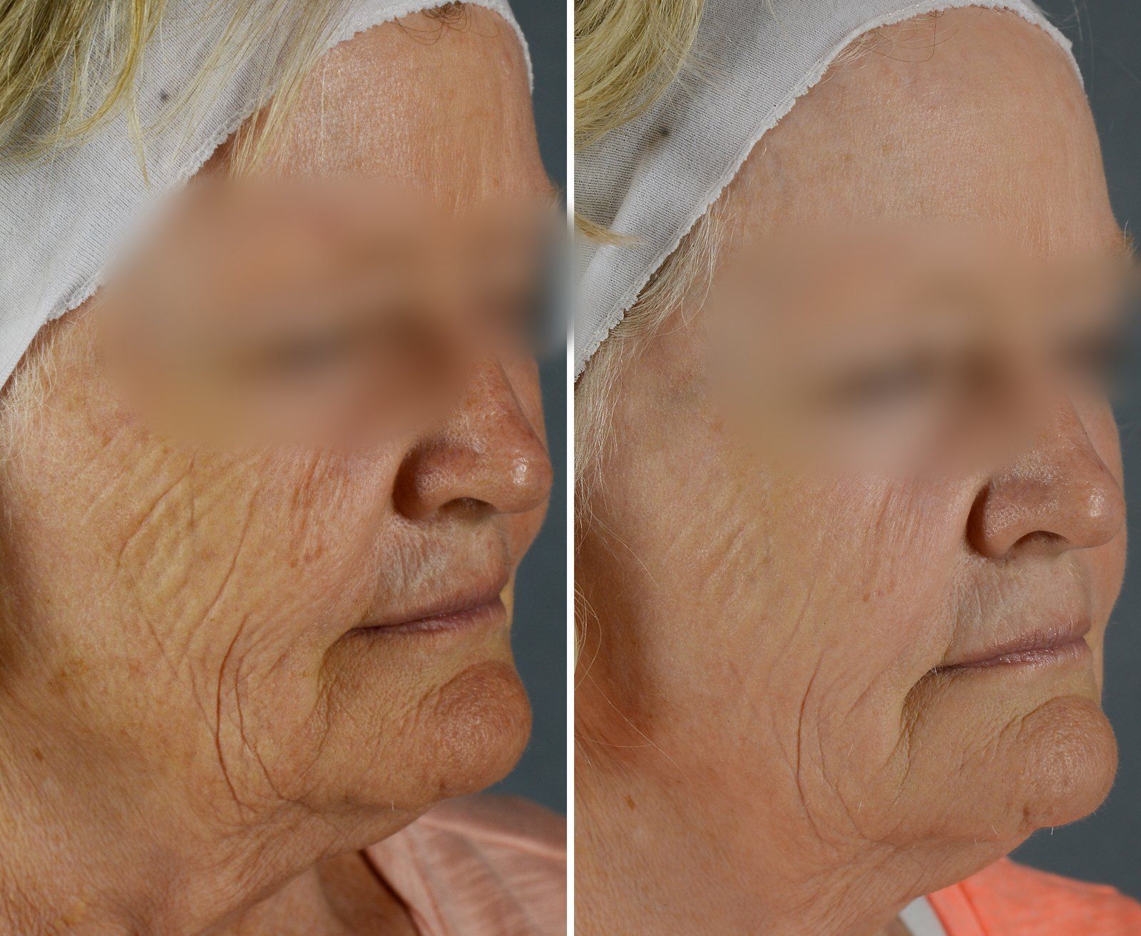 Before and after SenzaLux Max: Wrinkles & pigmentation. Before on the left, after on the right.