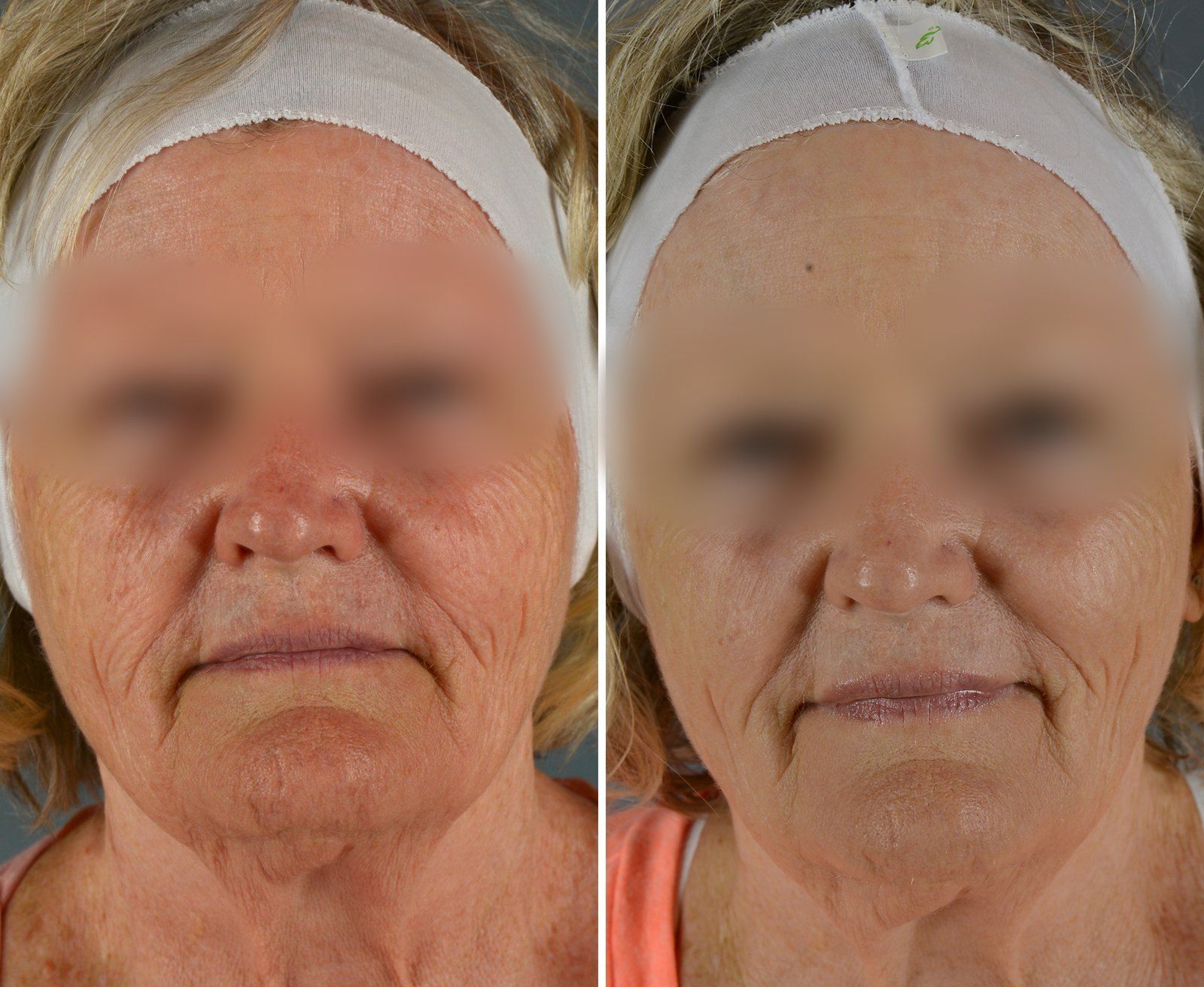 Before and after SenzaLux Max: Wrinkles & pigmentation. Before on the left, after on the right.