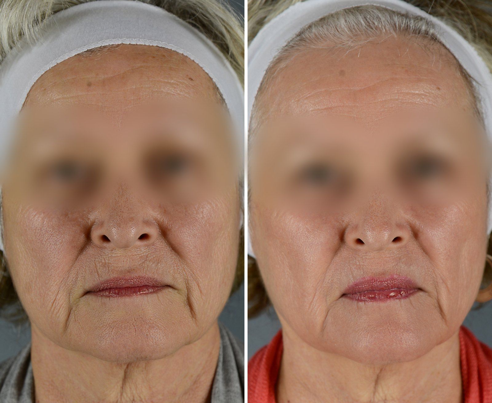 Before and after SenzaLux Max: Pigmentation & texture. Before on the left, after on the right.