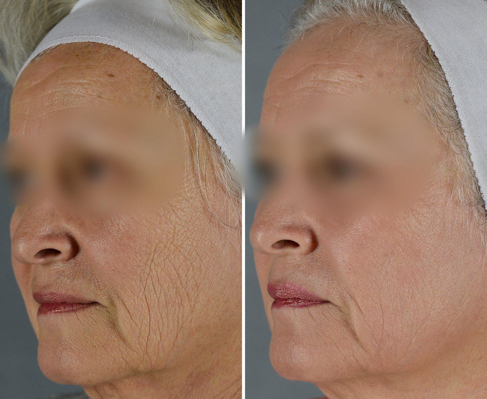 Before and after SenzaLux Max: Wrinkles & texture. Before on the left, after on the right.