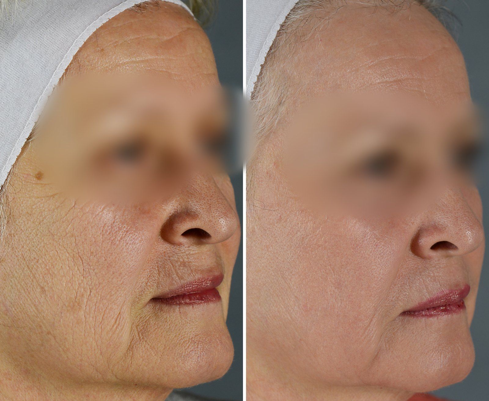Before and after SenzaLux Max: Wrinkles & pigmentation. Before on the left, after on the right.