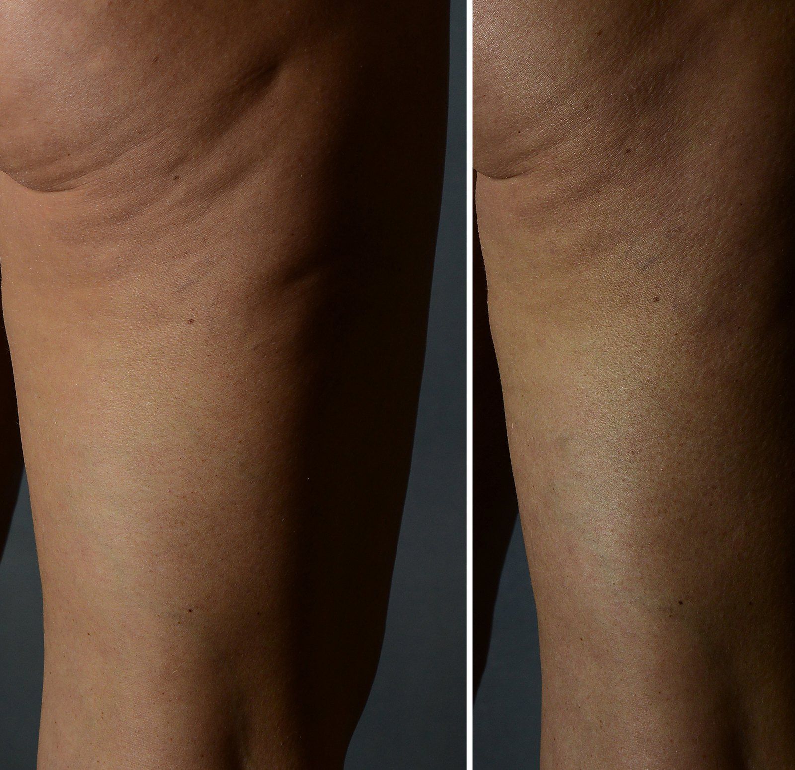 Before and after SenzaLipo: Thighs. Before on the left, after on the right.
