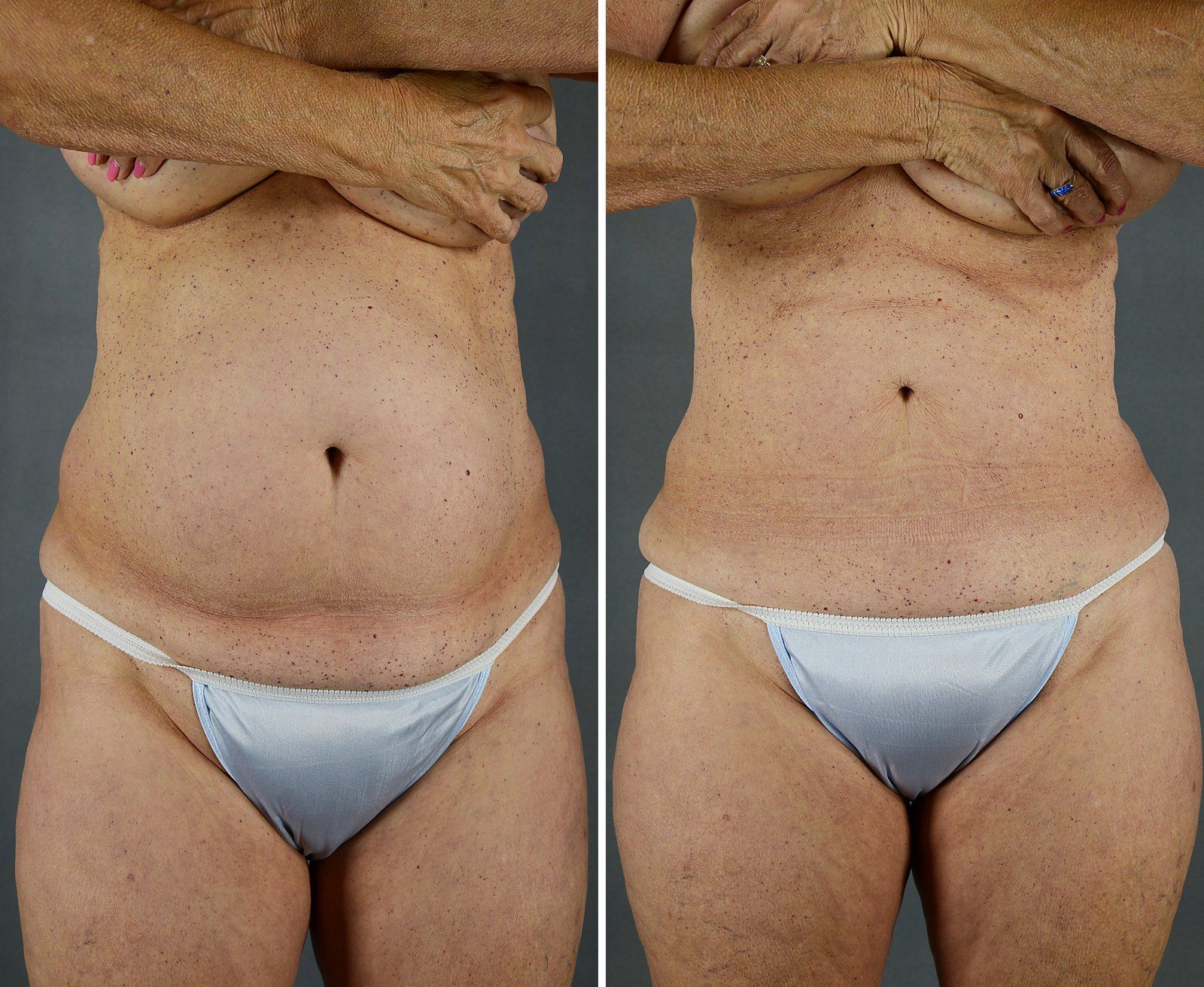 Before and after SenzaLipo: Abdomen. Before on the left, after on the right.