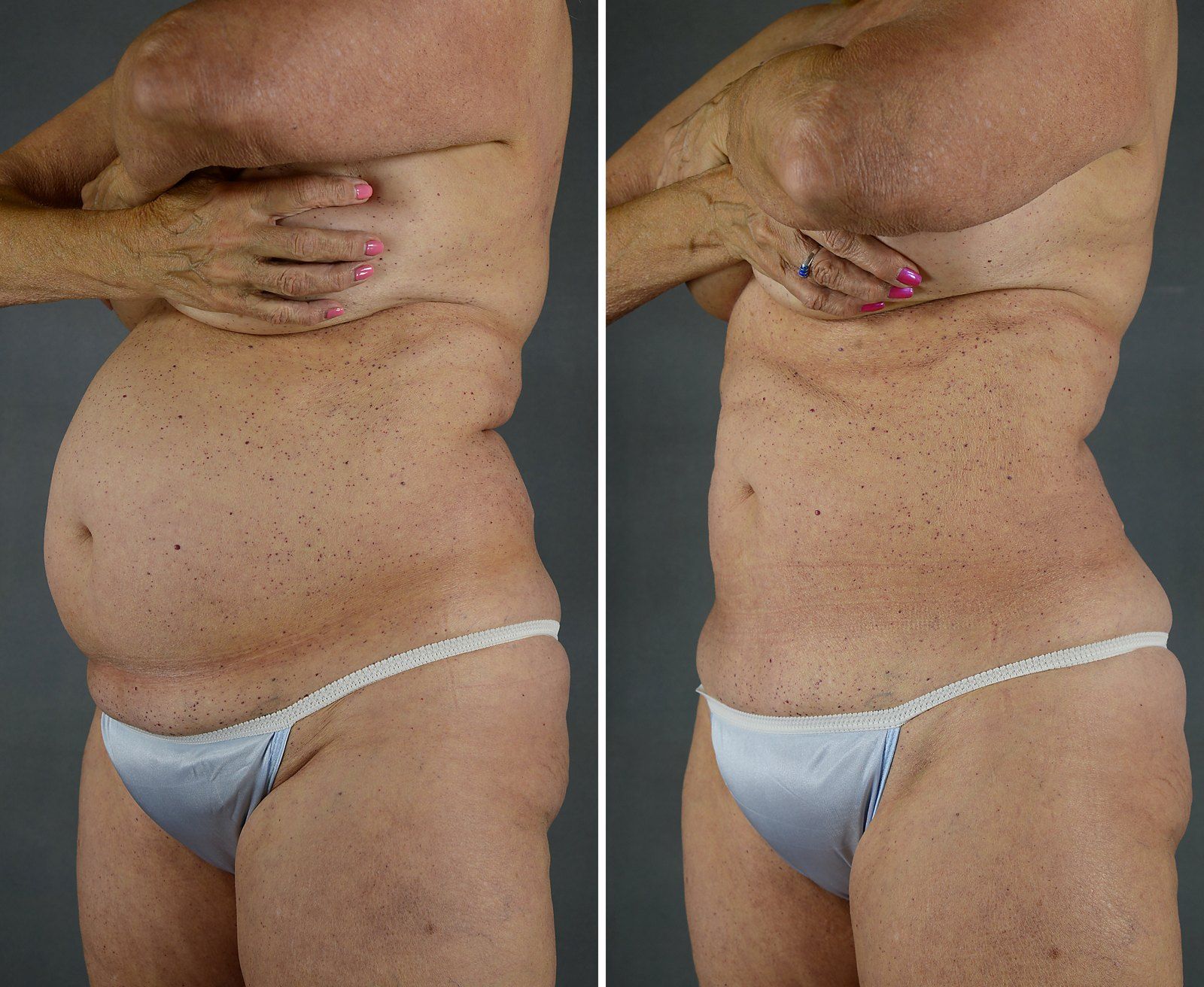 Before and after SenzaLipo: Abdomen & flanks. Before on the left, after on the right.