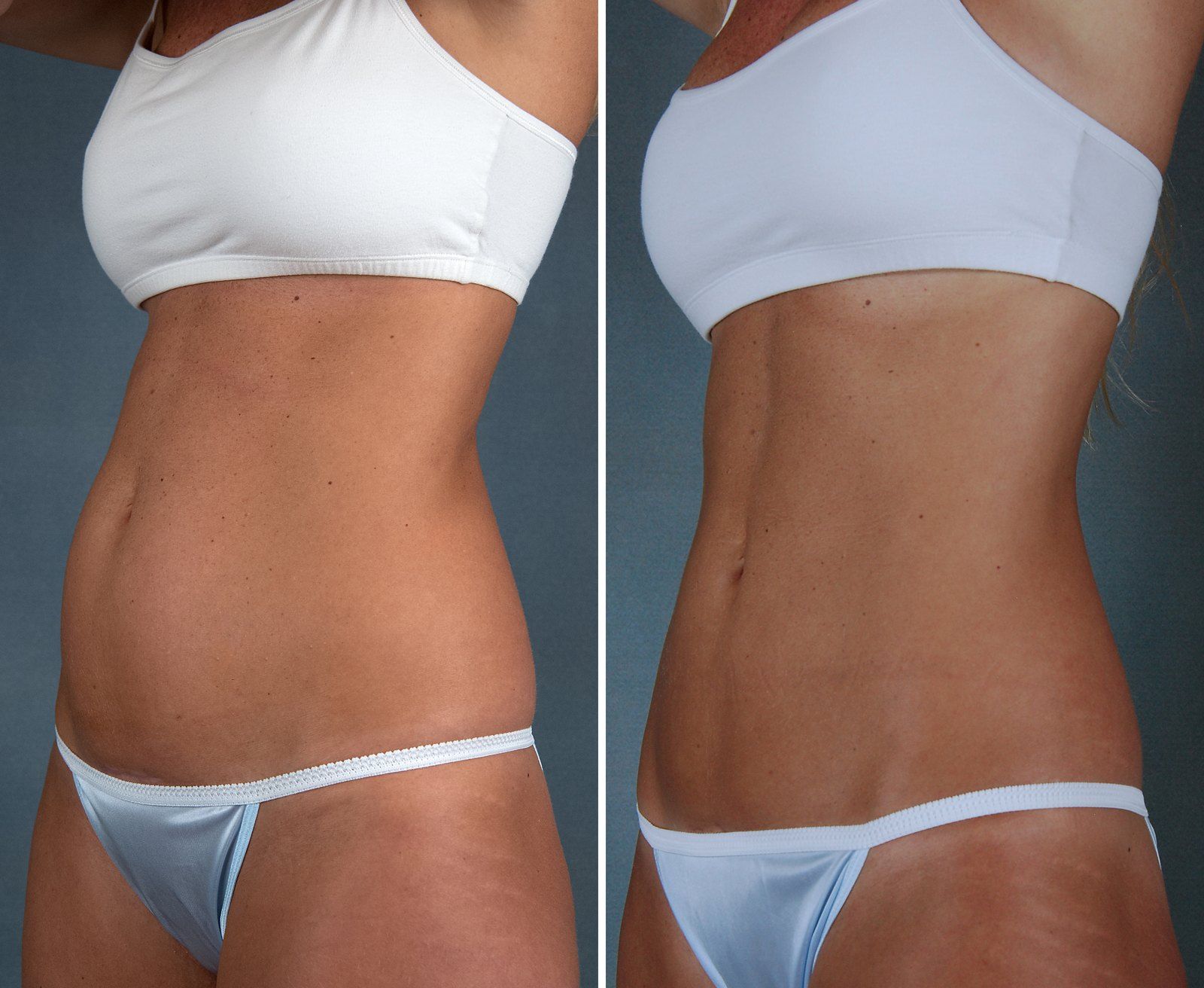 Before and after SenzaLipo: Abdomen. Before on the left, after on the right.